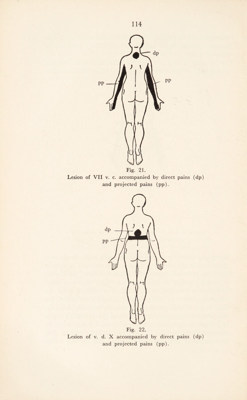 Fig. 21. Lesion of VII v. c. accompanied by direct pains (dp) and projected pains (pp). Fig. 22. Lesion of v. d. X accompanied by direct pains (dp) and projected pains (pp).