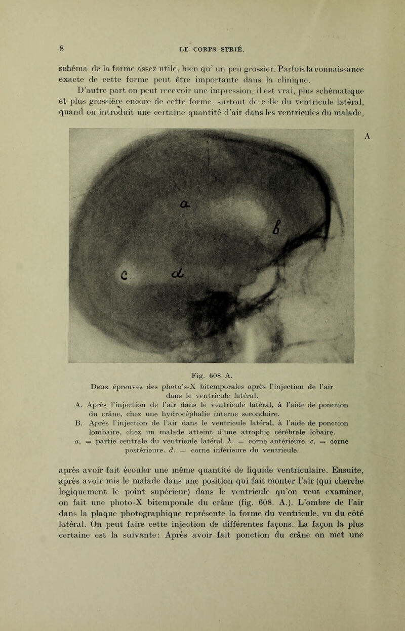 schéma de la forme assez utile, bien qu un peu grossier. Parfois la connaissance exacte de cette forme peut être importante flans la clinique. D’autre part on peut recevoir une impression, il est vrai, plus schématique et plus grossière encore de cette forme, surtout de celle du ventricule latéral, quand on introduit une certaine quantité d’air dans les ventricules du malade, Fig. 608 A. Deux épreuves des photo’s-X bitemporales après l’injection de l’air dans le ventricule latéral. A. Après l’injection de l’air dans le ventricule latéral, à l’aide de ponction du crâne, chez une hydrocéphalie interne secondaire. B. Api’ès l’injection de l’air dans le ventricule latéral, à l’aide de ponction lombaire, chez un malade atteint d’une atrophie cérébrale lobaire. a. = partie centrale du ventricule latéral, b. = corne antérieure, c. = corne postérieure, d. = corne inférieure du ventricule. après avoir fait écouler une même quantité de liquide ventriculaire. Ensuite, après avoir mis le malade dans une position qui fait monter l’air (qui cherche logiquement le point supérieur) dans le ventricule qu’on veut examiner, on fait une photo-X bitemporale du crâne (fig. 608. A.). L’ombre de l’air dans la plaque photographique représente la forme du ventricule, vu du côté latéral. On peut faire cette injection de différentes façons. La façon la plus certaine est la suivante: Après avoir fait ponction du crâne on met une