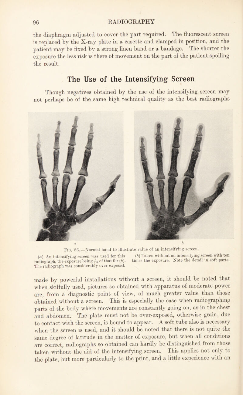 the diaphragm adjusted to cover the part required. The fluorescent screen is replaced by the X-ray plate in a casette and damped in position, and the patient may be fixed by a strong linen band or a bandage. The shorter the exposure the less risk is there of movement on the part of the patient spoiling the result. The Use of the Intensifying Screen Though negatives obtained by the use of the intensifying screen may not perhaps be of the same high technical quality as the best radiographs Fig. 86.—Normal hand to illustrate value of an intensifying screen. (a) An intensifying screen was used for this (6) Taken without an intensifying screen with ten radiograph, the exposure being Ty of that for (b). times the exposure. Note the detail in soft parts. The radiograph was considerably over-exposed. made by powerful installations without a screen, it should be noted that when skilfully used, pictures so obtained with apparatus of moderate power are, from a diagnostic point of view, of much greater value than those obtained without a screen. This is especially the case when radiographing parts of the body where movements are constantly going on, as in the chest and abdomen. The plate must not be over-exposed, otherwise grain, due to contact with the screen, is bound to appear. A soft tube also is necessary when the screen is used, and it should be noted that there is not quite the same degree of latitude in the matter of exposure, but when all conditions are correct, radiographs so obtained can hardly be distinguished from those taken without the aid of the intensifying screen. This applies not only to the plate, but more particularly to the print, and a little experience with an