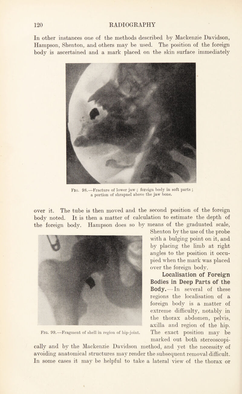 In other instances one of the methods described by Mackenzie Davidson, Hampson, Shenton, and others may be used. The position of the foreign body is ascertained and a mark placed on the skin surface immediately Fig. 98.—Fracture of lower jaw ; foreign body in soft parts ; a portion of shrapnel above the jaw bone. over it. The tube is then moved and the second position of the foreign body noted. It is then a matter of calculation to estimate the depth of the foreign body. Hampson does so by means of the graduated scale, Shenton by the use of the probe with a bulging point on it, and by placing the limb at right angles to the position it occu¬ pied when the mark was placed over the foreign body. Localisation of Foreign Bodies in Deep Parts of the Body. -—In several of these regions the localisation of a foreign body is a matter of extreme difficulty, notably in the thorax abdomen, pelvis, axilla and region of the hip. The exact position may be marked out both stereoscopi- cally and by the Mackenzie Davidson method, and yet the necessity of avoiding anatomical structures may render the subsequent removal difficult. In some cases it may be helpful to take a lateral view of the thorax or