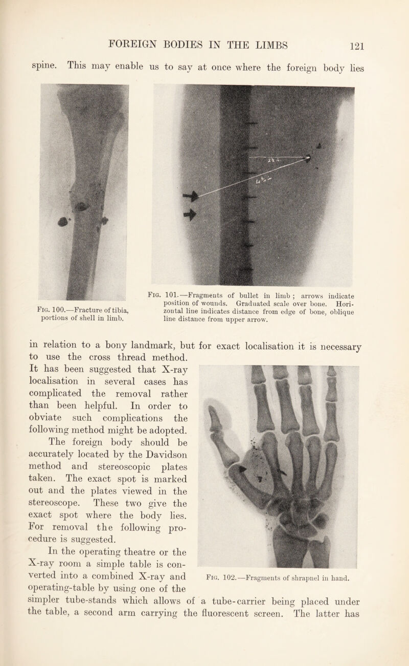 spine. This may enable us to say at once where the foreign body lies Fig. 100.—Fracture of tibia, portions of shell in limb. Fig. 101.—Fragments of bullet in limb ; arrows indicate position of wounds. Graduated scale over bone. Hori¬ zontal line indicates distance from edge of bone, oblique line distance from upper arrow. in relation to a bony landmark, but for exact localisation it is necessary to use the cross thread method. It has been suggested that X-ray localisation in several cases has complicated the removal rather than been helpful. In order to obviate such complications the following method might be adopted. The foreign body should be accurately located by the Davidson method and stereoscopic plates taken. The exact spot is marked out and the plates viewed in the stereoscope. These two give the exact spot where the body lies. For removal the following pro¬ cedure is suggested. In the operating theatre or the X-ray room a simple table is con¬ verted into a combined X-ray and operating-table by using one of the Fig. 102.—Fragments of shrapnel in hand. simpler tube-stands which allows of a tube-carrier being placed under the table, a second arm carrying the fluorescent screen. The latter has