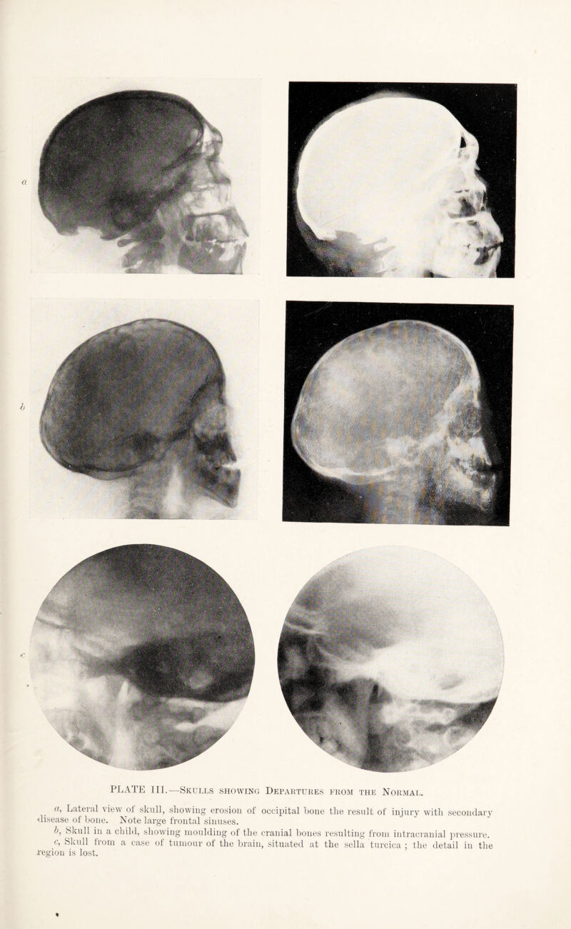 PLATE III.—Skulls showing Departures from the Normal. a, Lateral view of skull, showing erosion of occipital hone the result of injury with secondary ■disease of hone. Note large frontal sinuses. h. Skull in a child, showing moulding of the cranial bones resulting from intracranial pressure. c, Skull from a case of tumour of the brain, situated at the sella turcica ; the detail in the region is lost.