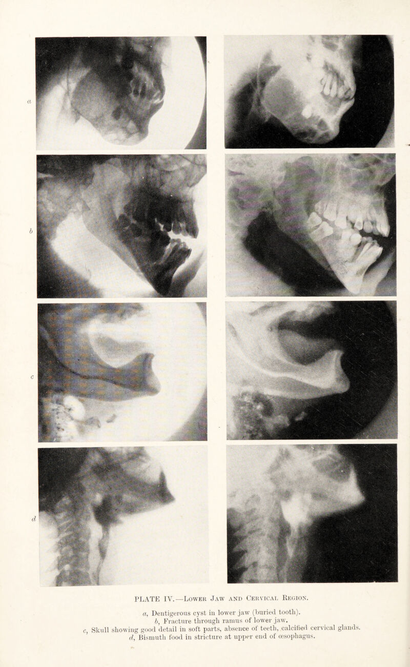 PLATE IV.—Lower Jaw and Cervical Region. a, Dentigerous cyst in lower jaw (buried tooth). b, Fracture through ramus of lower jaw. c, Skull showing good detail in soft parts, absence ot teeth, calcified cervical glands. d, Bismuth food in stricture at upper end of oesophagus.