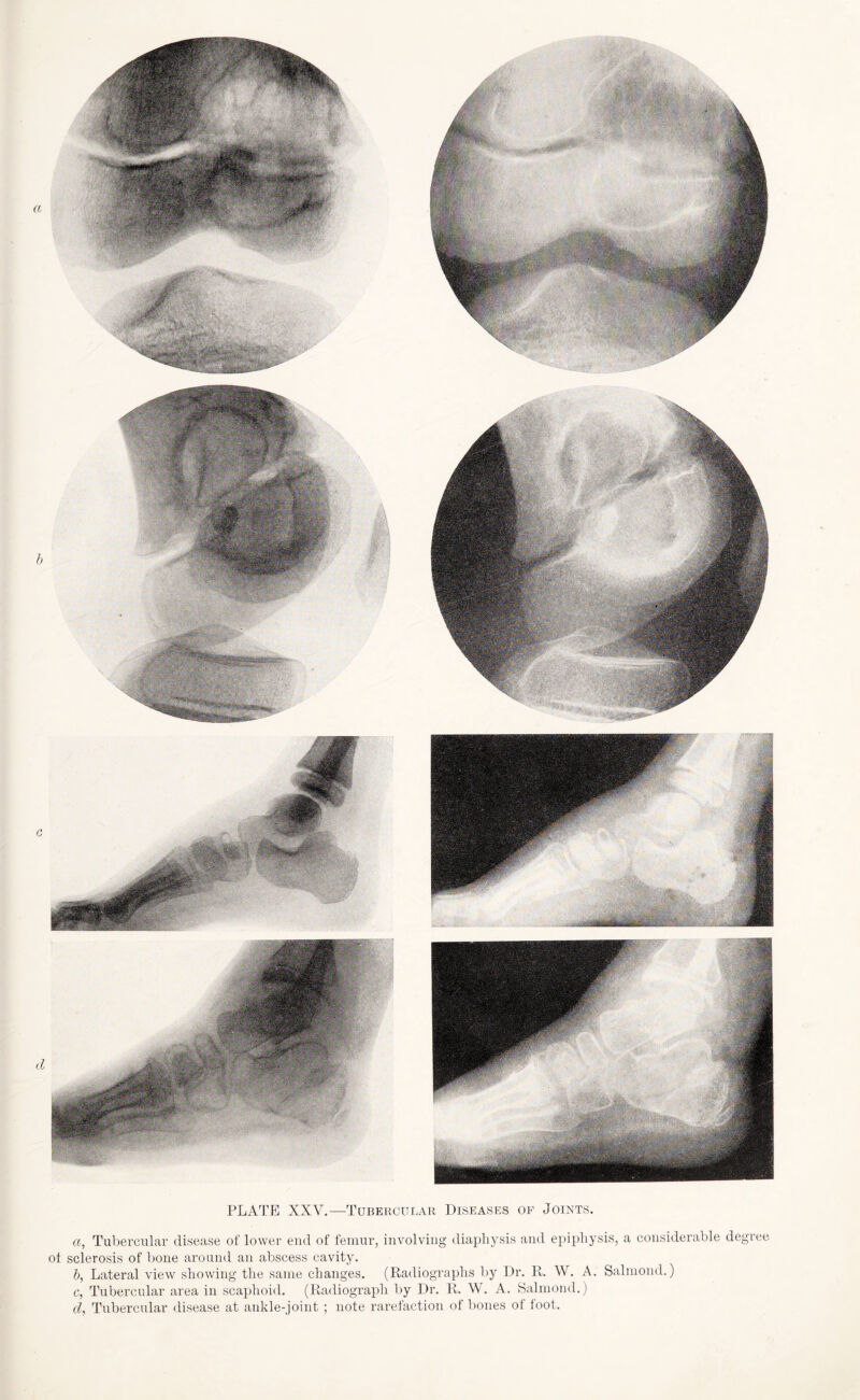 а, Tubercular disease of lower end of femur, involving diaphysis and epiphysis, a considerable degree ol sclerosis of bone around an abscess cavity. б, Lateral view showing the same changes. (Radiographs by Dr. R. W. A. Salmond.) c, Tubercular area in scaphoid. (Radiograph by Dr. R. W. A. Salmond.) d, Tubercular disease at ankle-joint ; note rarefaction of bones of loot.