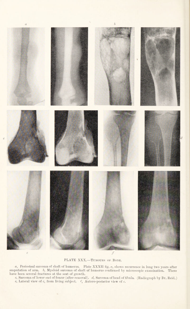 a, Periosteal sarcoma of shaft of humerus. Plate XXXT1 fig. a, shows recurrence in lung two years after amputation ot arm. b, Myeloid sarcoma of shaft of humerus confirmed by microscopic examination. There have been several fractures at the seat of growth. c, Sarcoma of lower end of femur (after removal), d, Sarcoma of head of fibula. (Badiograph by Dr. Beid.) e. Lateral view of c, from living subject, f, Antero-posterior view of c.