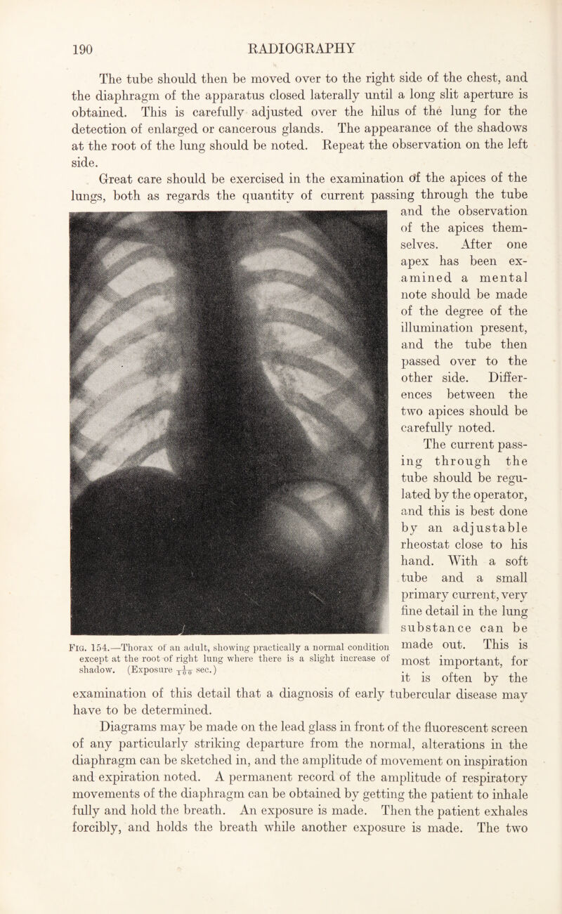 The tube should then be moved over to the right side of the chest, and the diaphragm of the apparatus closed laterally until a long slit aperture is obtained. This is carefully adjusted over the hilus of the lung for the detection of enlarged or cancerous glands. The appearance of the shadows at the root of the lung should be noted. Repeat the observation on the left side. Great care should be exercised in the examination oif the apices of the lungs, both as regards the quantity of current passing through the tube and the observation of the apices them¬ selves. After one apex has been ex¬ amined a mental note should be made of the degree of the illumination present, and the tube then passed over to the other side. Differ¬ ences between the two apices should be carefully noted. The current pass¬ ing through the tube should be regu¬ lated by the operator, and this is best done by an adjustable rheostat close to his hand. With a soft tube and a small primary current, very fine detail in the lung substance can be made out. This is most important, for it is often by the examination of this detail that a diagnosis of early tubercular disease may have to be determined. Diagrams may be made on the lead glass in front of the fluorescent screen of any particularly striking departure from the normal, alterations in the diaphragm can be sketched in, and the amplitude of movement on inspiration and expiration noted. A permanent record of the amplitude of respiratory movements of the diaphragm can be obtained by getting the patient to inhale fully and hold the breath. An exposure is made. Then the patient exhales forcibly, and holds the breath while another exposure is made. The two Fig. 154.—Thorax of an adult, showing practically a normal condition the root of right lun shadow. (Exposure sec.) except at the root of right lung where there is a slight increase of