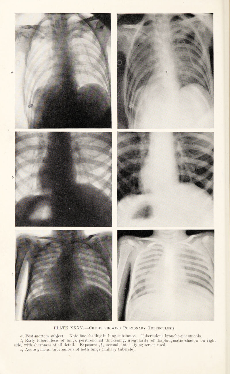 a, Post-mortem subject. Note fine shading in lung substance. Tuberculous bronclio-pneumonia. b, Early tuberculosis of lungs, peribronchial thickening, irregularity of diaphragmatic shadow on right side, with sharpness of all detail. Exposure second, intensifying screen used. c, Acute general tuberculosis of both lungs (miliary tubercle).