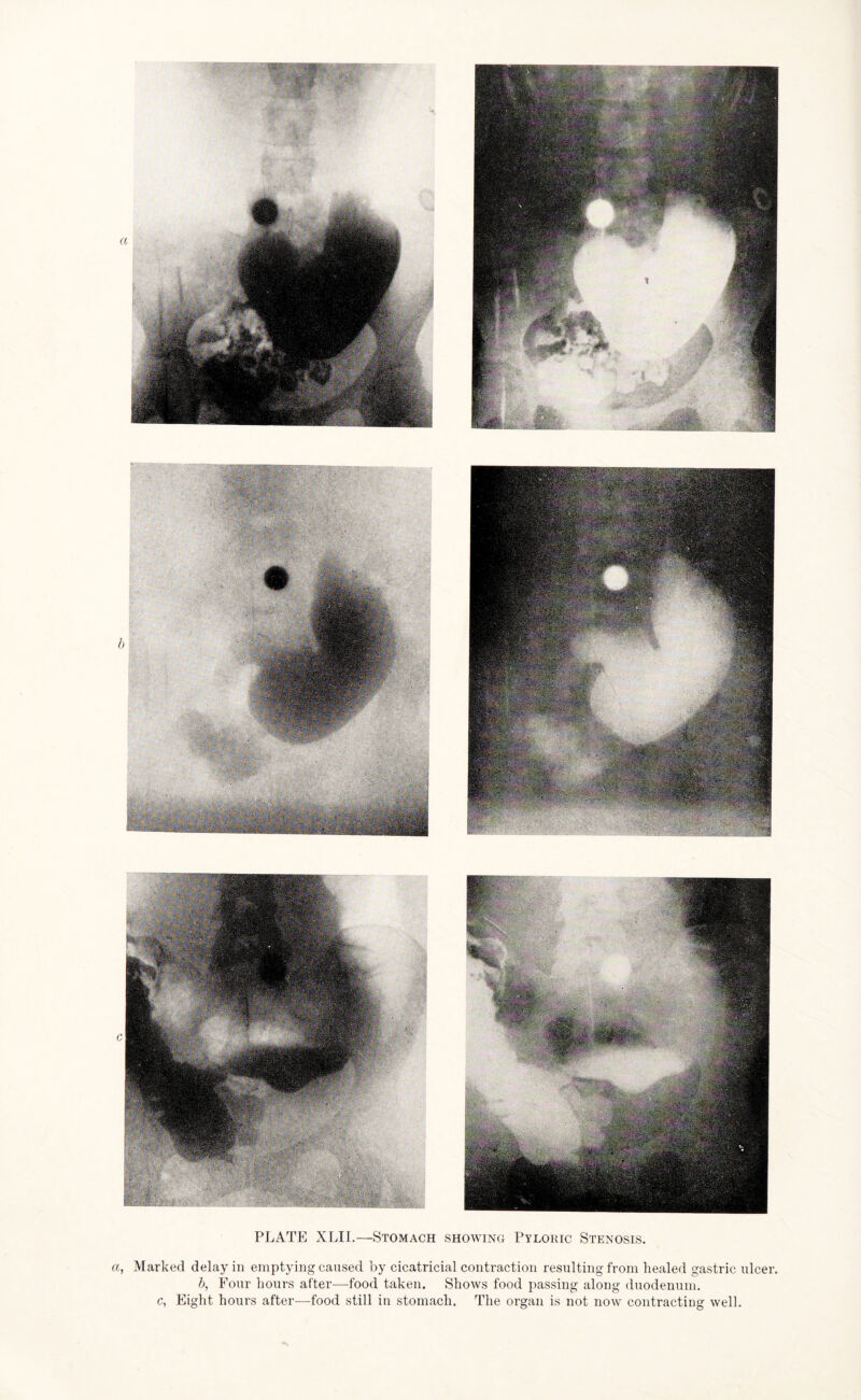 PLATE XLII.—Stomach showing Pyloric Stenosis. a, Marked delay in emptying caused by cicatricial contraction resulting from healed gastric ulcer b, Four hours after—food taken. Shows food passing along duodenum, c, Eight hours after—food still in stomach. The organ is not now contracting well.