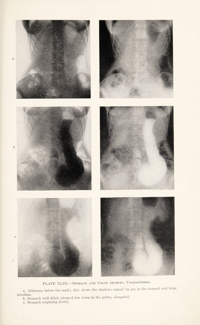 PLATE XLIII.—Stomach and Colon showing Visceroptosis. a, Abdomen before the meal; this shows the shadows caused by gas in the stomach and large intestine. . , b, Stomach well filled, situated low down in the pelvis, elongated. c, Stomach emptying slowly.