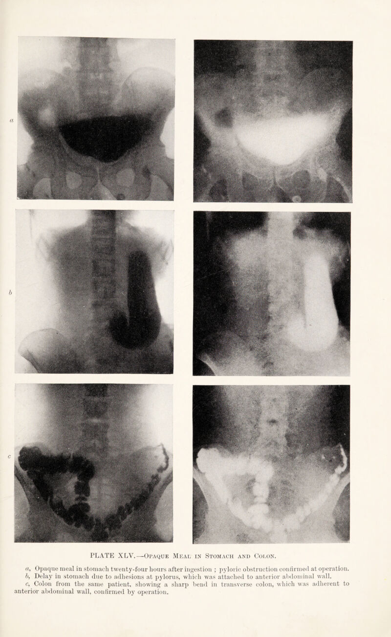 PLATE XLY.—Opaque Meal in Stomach and Colon. ci, Opaque meal in stomach twenty-four hours after ingestion ; pyloric obstruction confirmed at operation. b, Delay in stomach due to adhesions at pylorus, which was attached to anterior abdominal wall. c, Colon from the same patient, showing a sharp bend in transverse colon, which was adherent to anterior abdominal wall, confirmed by operation.