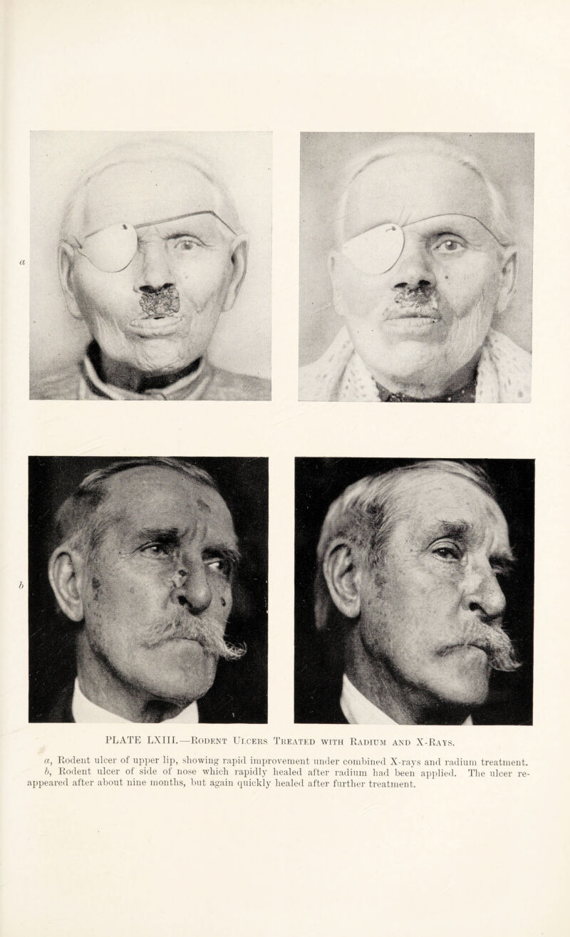 PLATE LXIII.— Rodent Ulcers Treated with Radium and X-Rays. a, Rodent ulcer of upper lip, showing rapid improvement under combined X-rays and radium treatment. b, Rodent ulcer of side of nose which rapidly healed after radium had been applied. The ulcer re¬ appeared after about nine months, but again quickly healed after further treatment.