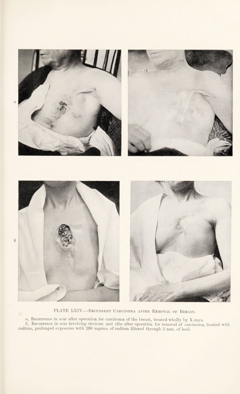 PLATE LXI\ .—Recurrent Carcinoma after Removal of Breast. a, Recurrence in scar after operation for carcinoma of the breast, treated wholly by X-rays. b, Recurrence in scar involving sternum and ribs after operation for removal of carcinoma, treated with radium, prolonged exposures with 200 mgrms. of radium filtered through 3 mm. of lead.