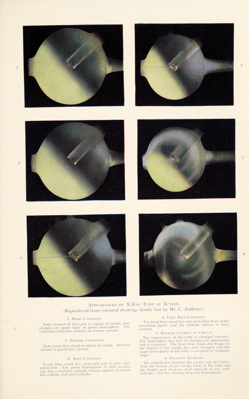 1- a <> Appearances of X-Ray Tube in Action, i Reproduced from coloured drawing's kindly lent by Mr. C. Andrews.) 1. Hard Condition. Note absence of blue gas in region of anode, also sharply-cut upper limit of green hemisphere. 1 he condition indicates absence of reverse current. •>. Normal Condition. Note faint blue cloud in region of anode. Reverse current is practically absent. Soft Condition. Faint blue cloud has increased and is now very noticeable. The green hemisphere is still sharply cut, but a distinct cathode stream appears between the cathode and anti-cathode. 4. Very Soft Condition. The faint blue cloud has spread farther than in the preceding figure, and the cathode stream is more evident. a. Reverse Current in Circuit. The appearance of the tube is changed entirely. The hemisphere has lost its sharply-cut appearance and is irregular. 1 he faint blue cloud, due to gas in the region of the anode, has also changed, and the upper hemisphere of the tube is occupied by irregular rings. 6. Polarity Reversed. The cathode has become the anode and vice verm. Note the stream of gas at the back of the tube and the bright spot on glass wall opposite to 111e anti¬ cathode; also the absence of green hemisphere.