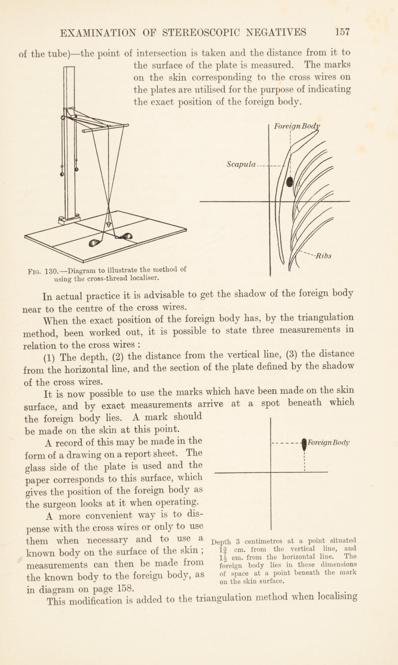 of the tube)- -the point of intersection is taken and the distance from it to the surface of the plate is measured. The marks on the skin corresponding to the cross wires on the plates are utilised for the purpose of indicating the exact position of the foreign body. Foreign Bodi Fig. 130.—Diagram to illustrate the method of using the cross-thread localiser. In actual practice it is advisable to get the shadow of the foreign body near to the centre of the cross wires. When the exact position of the foreign body has, by the triangulation method, been worked out, it is possible to state three measurements in relation to the cross wires : (1) The depth, (2) the distance from the vertical line, (3) the distance from the horizontal line, and the section of the plate defined by the shadow of the cross wires. It is now possible to use the marks which have been made on the skin surface, and by exact measurements arrive at a spot beneath which the foreign body lies. A mark should be made on the skin at this point. A record of this may be made in the form of a drawing on a report sheet. The -^Foreign Body glass side of the plate is used and the paper corresponds to this surface, which gives the position of the foreign body as the surgeon looks at it when operating. A more convenient way is to dis¬ pense with the cross wires or only to use them when necessary and to use a known body on the surface of the skin , measurements can then be made from the known body to the foreign body, as Depth 3 centimetres at a point situated If cm. from the vertical line, and in cm. from the horizontal line. The foreign body lies in these dimensions of space at a point beneath the mark on the skin surface. in diagram on page 158. . This modification is added to the triangulation method when localising