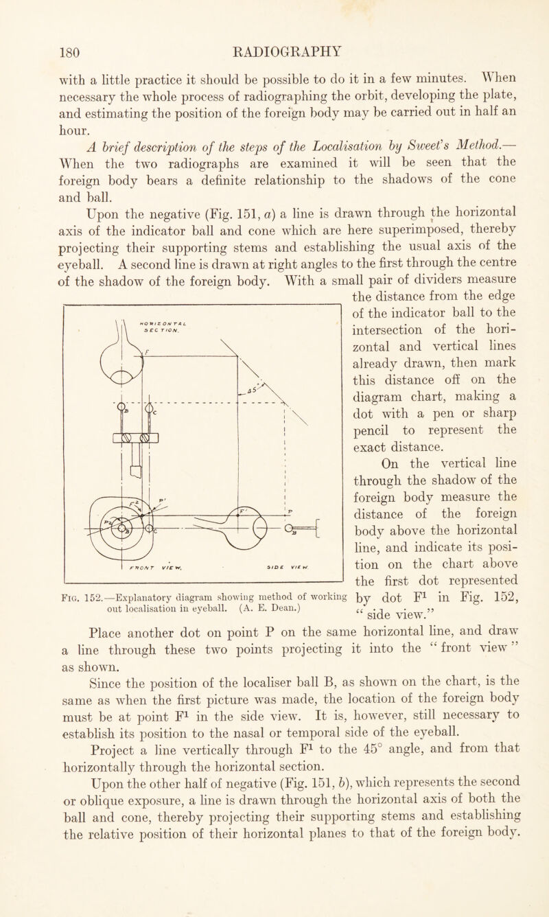 with a little practice it should be possible to do it in a few minutes. When necessary the whole process of radiographing the orbit, developing the plate, and estimating the position of the foreign body may be carried out in half an hour. A brief description of the steps of the Localisation by Sweet's Method.— When the twm radiographs are examined it will be seen that the foreign body bears a definite relationship to the shadows of the cone and ball. Upon the negative (Fig. 151, a) a line is drawn through the horizontal axis of the indicator ball and cone which are here superimposed, thereby projecting their supporting stems and establishing the usual axis of the eyeball. A second line is drawn at right angles to the first through the centre of the shadow of the foreign body. With a small pair of dividers measure the distance from the edge of the indicator ball to the intersection of the hori¬ zontal and vertical lines already drawn, then mark this distance off on the diagram chart, making a dot with a pen or sharp pencil to represent the exact distance. On the vertical line through the shadow of the foreign body measure the distance of the foreign body above the horizontal line, and indicate its posi¬ tion on the chart above the first dot represented Fig. 152.—Explanatory diagram showing method of working py (tot F1 ill Fig. 152, out localisation in eyeball. (A. E. Dean.) (C . . ,, J side view. Place another dot on point P on the same horizontal line, and draw a line through these two points projecting it into the “ front view ” as shown. Since the position of the localiser ball B, as shown on the chart, is the same as when the first picture was made, the location of the foreign body must be at point F1 in the side view. It is, however, still necessary to establish its position to the nasal or temporal side of the eyeball. Project a line vertically through F1 to the 45° angle, and from that horizontally through the horizontal section. Upon the other half of negative (Fig. 151, b), which represents the second or oblique exposure, a line is drawn through the horizontal axis of both the ball and cone, thereby projecting their supporting stems and establishing the relative position of their horizontal planes to that of the foreign body.