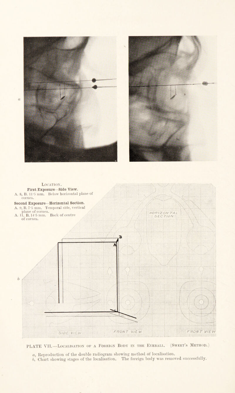 Location. First Exposure—Side View. A. 8, B. 11-5 mm. Below horizontal plane of cornea. Second Exposure—Horizontal Section. A. 9, B. 7-5 mm. Temporal side, vertical plane of cornea. A. 11, B. 14-5 mm. Back of centre of cornea. ' RQR t ZQAf TA L SEC TlON ■ 1 r r : ... ...... A ■ 't„:.... a : . A- . ■ l ”'7\ ■ ■'y'~X'T.':'C7'7jvX ftTTTiT S' I • ■ ' r rr“ | . . . .. — a^aa. jst i— sea* ill; ■■ . ■- ■ - ' - U£>1 ’ i C. sfV • FRONT VSEW FRONT VIEW PLATE YII.—Localisation of a Foreign Body in the Eyeball. (Sweet’s Method.) a, Reproduction of the double radiogram showing method of localisation. b, Chart showing stages of the localisation. The foreign body was removed successfully.