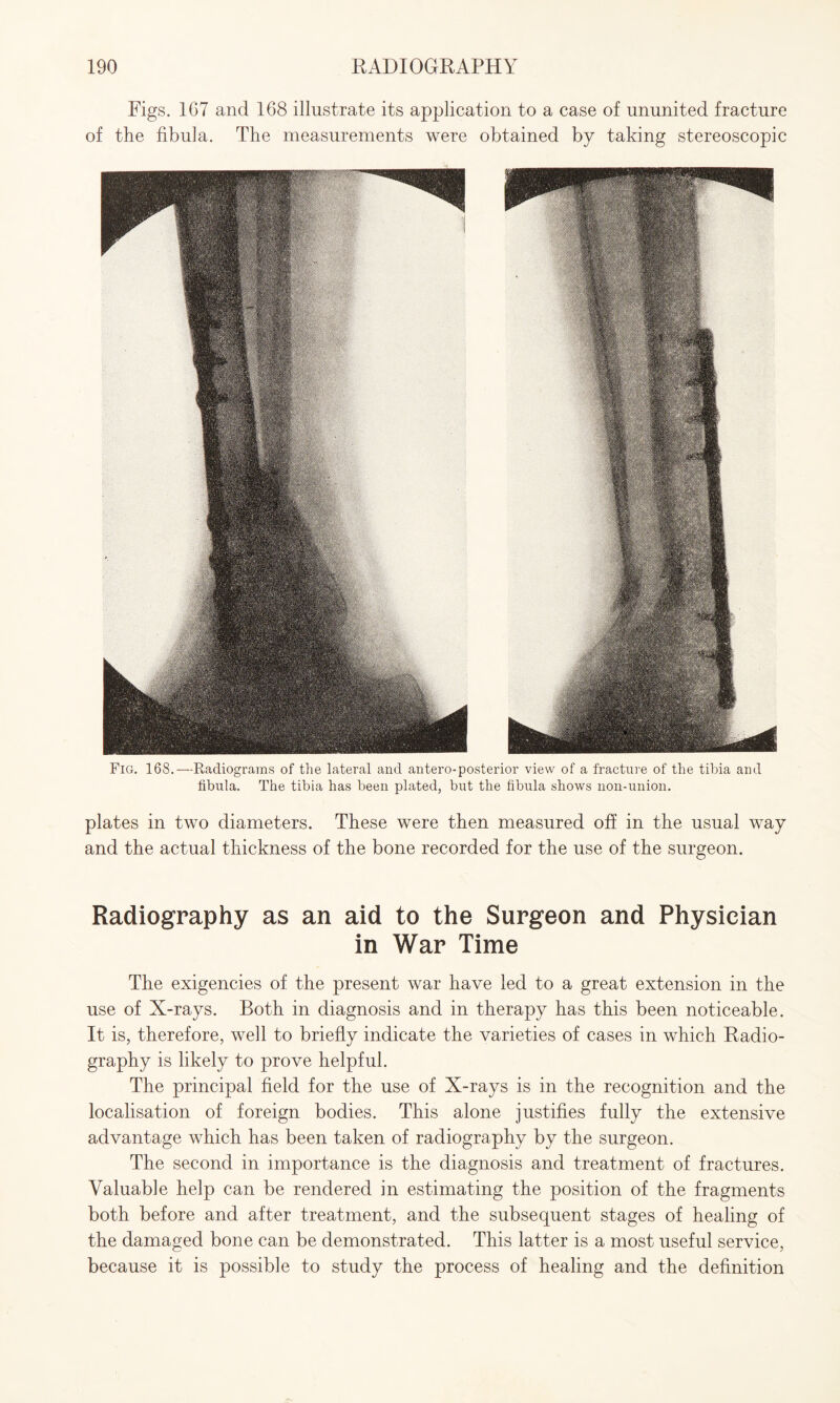 Figs. 167 and 168 illustrate its application to a case of ununited fracture of the fibula. The measurements were obtained by taking stereoscopic Fig. 168.—Radiograms of the lateral and antero-posterior view of a fracture of the tibia and fibula. The tibia has been plated, but the fibula shows non-union. plates in two diameters. These were then measured off in the usual way and the actual thickness of the bone recorded for the use of the surgeon. Radiography as an aid to the Surgeon and Physician in War Time The exigencies of the present war have led to a great extension in the use of X-rays. Both in diagnosis and in therapy has this been noticeable. It is, therefore, well to briefly indicate the varieties of cases in which Radio¬ graphy is likely to prove helpful. The principal field for the use of X-rays is in the recognition and the localisation of foreign bodies. This alone justifies fully the extensive advantage which has been taken of radiography by the surgeon. The second in importance is the diagnosis and treatment of fractures. Valuable help can be rendered in estimating the position of the fragments both before and after treatment, and the subsequent stages of healing of the damaged bone can be demonstrated. This latter is a most useful service, because it is possible to study the process of healing and the definition