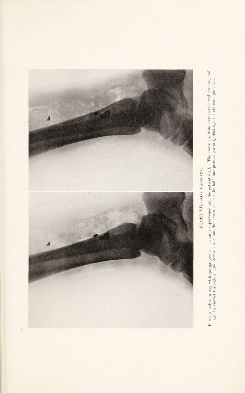 Foreign bodies in leg, with gas gangrene. Tetanus supervened and the patient died. The above are from stereoscopic radiograms, and can be viewed through a hand stereoscope ; but the screen used in the half-tone process partially destroys the stereoscopic effect.