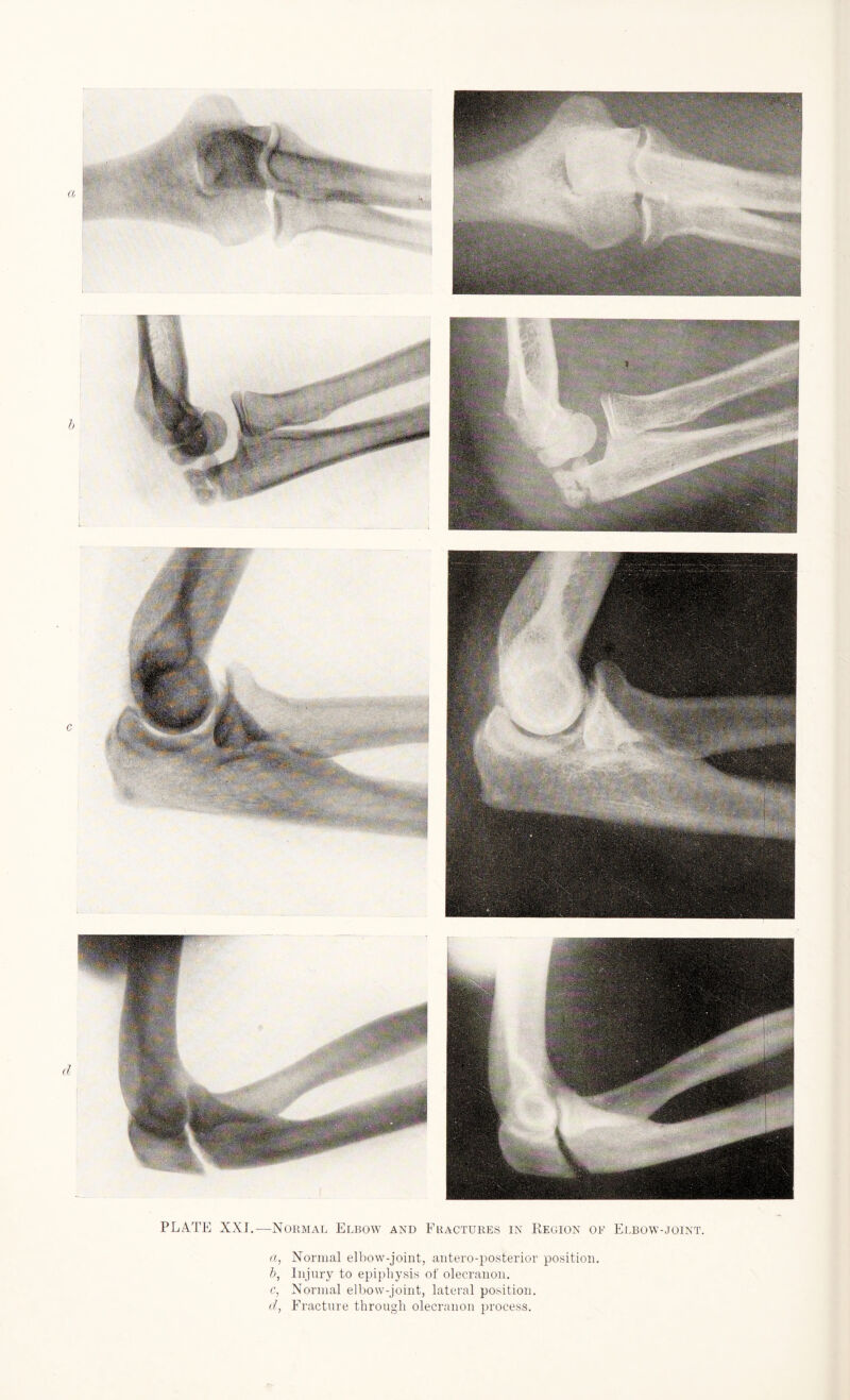 Normal Elbow and Fractures in Region of Elbow-joint a, Normal elbow-joint, antero-posterior position. b, Injury to epiphysis of olecranon. c, Normal elbow-joint, lateral position. d, Fracture through olecranon process.