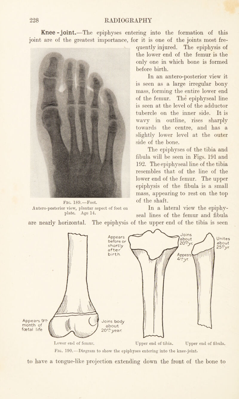 Knee - joint.—The epiphyses entering into the formation of this joint are of the greatest importance, for it is one of the joints most fre¬ quently injured. The epiphysis of the lower end of the femur is the only one in which bone is formed before birth. In an antero-posterior view it is seen as a large irregular bony mass, forming the entire lower end of the femur. The epiphyseal line is seen at the level of the adductor tubercle on the inner side. It is wavy in outline, rises sharply towards the centre, and has a slightly lower level at the outer side of the bone. The epiphyses of the tibia and fibula will be seen in Figs. 191 and 192. The epiphyseal line of the tibia resembles that of the line of the lower end of the femur. The upper epiphysis of the fibula is a small mass, appearing to rest on the top of the shaft. In a lateral view the epiphy¬ seal lines of the femur and fibula are nearly horizontal. The epiphysis of the upper end of the tibia is seen Fig. 189.—Foot. Antero-posterior view, plantar aspect of foot on plate. Age 14. Fig. 190.—Diagram to show the epiphyses entering into the knee-joint. to have a tongue-like projection extending down the front of the bone to