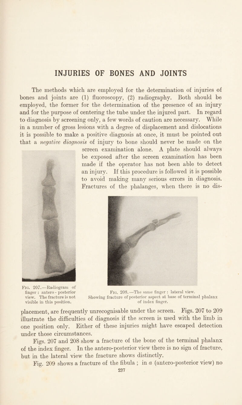 INJURIES OF BONES AND JOINTS The methods which are employed for the determination of injuries of bones and joints are (1) fluoroscopy, (2) radiography. Both should be employed, the former for the determination of the presence of an injury and for the purpose of centering the tube under the injured part. In regard to diagnosis by screening only, a few words of caution are necessary. While in a number of gross lesions with a degree of displacement and dislocations it is possible to make a positive diagnosis at once, it must be pointed out that a negative diagnosis of injury to bone should never be made on the screen examination alone. A plate should always be exposed after the screen examination has been made if the operator has not been able to detect an injury. If this procedure is followed it is possible to avoid making many serious errors in diagnosis. Fractures of the phalanges, when there is no dis- Fig. 207.—Radiogram of finger : antero - posterior view. The fracture is not visible in this position. Fig. 208.—The same finger : lateral view. Showing fracture of posterior aspect at base of terminal phalanx of index finger. placement, are frequently unrecognisable under the screen. Figs. 207 to 209 illustrate the difficulties of diagnosis if the screen is used with the limb in one position only. Either of these injuries might have escaped detection under those circumstances. Figs. 207 and 208 show a fracture of the bone of the terminal phalanx of the index finger. In the antero-posterior view there is no sign of fracture, but in the lateral view the fracture shows distinctly. Fig. 209 shows a fracture of the fibula ; in a (antero-posterior view) no