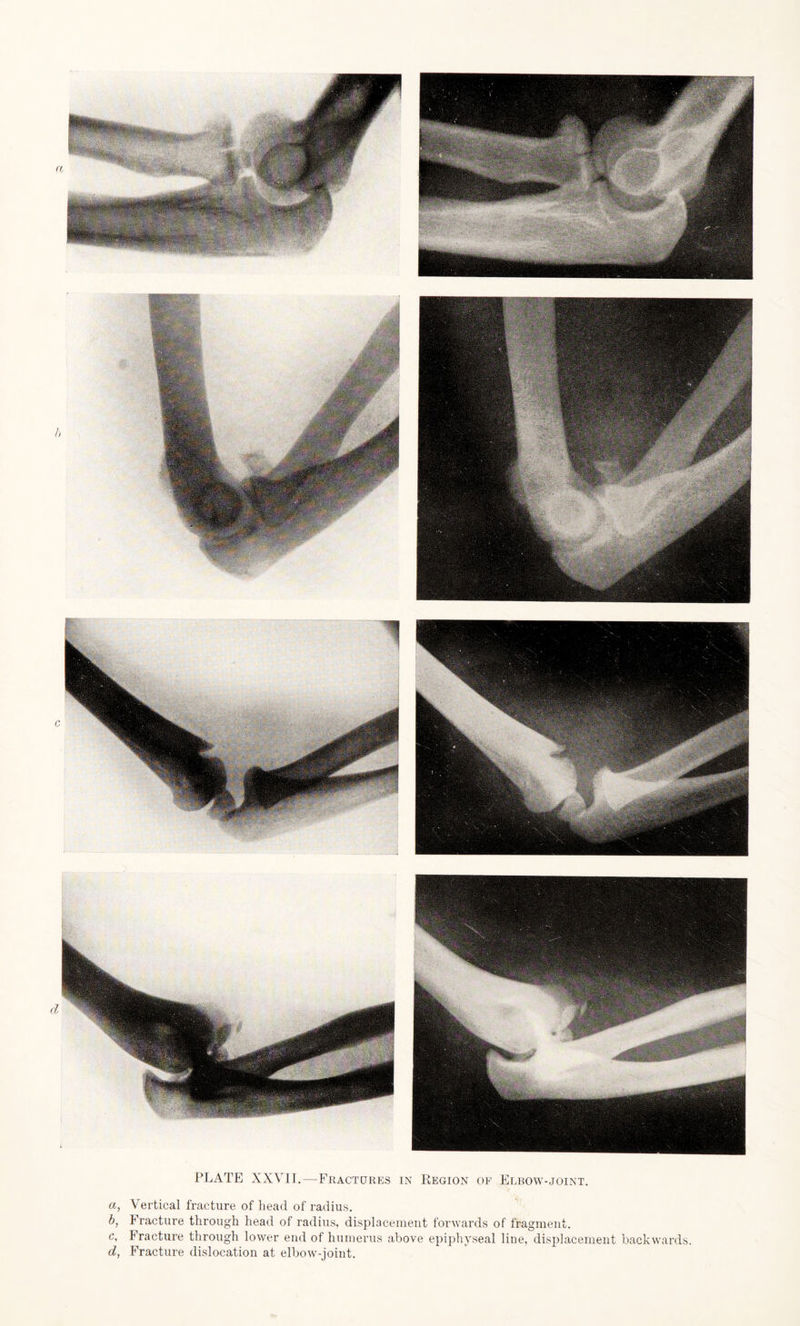 a, Vertical fracture of head of radius. b, Fracture through head of radius, displacement forwards of fragment. c, Fracture through lower end of humerus above epiphyseal line, displacement backwards. d, Fracture dislocation at elbow-joint.