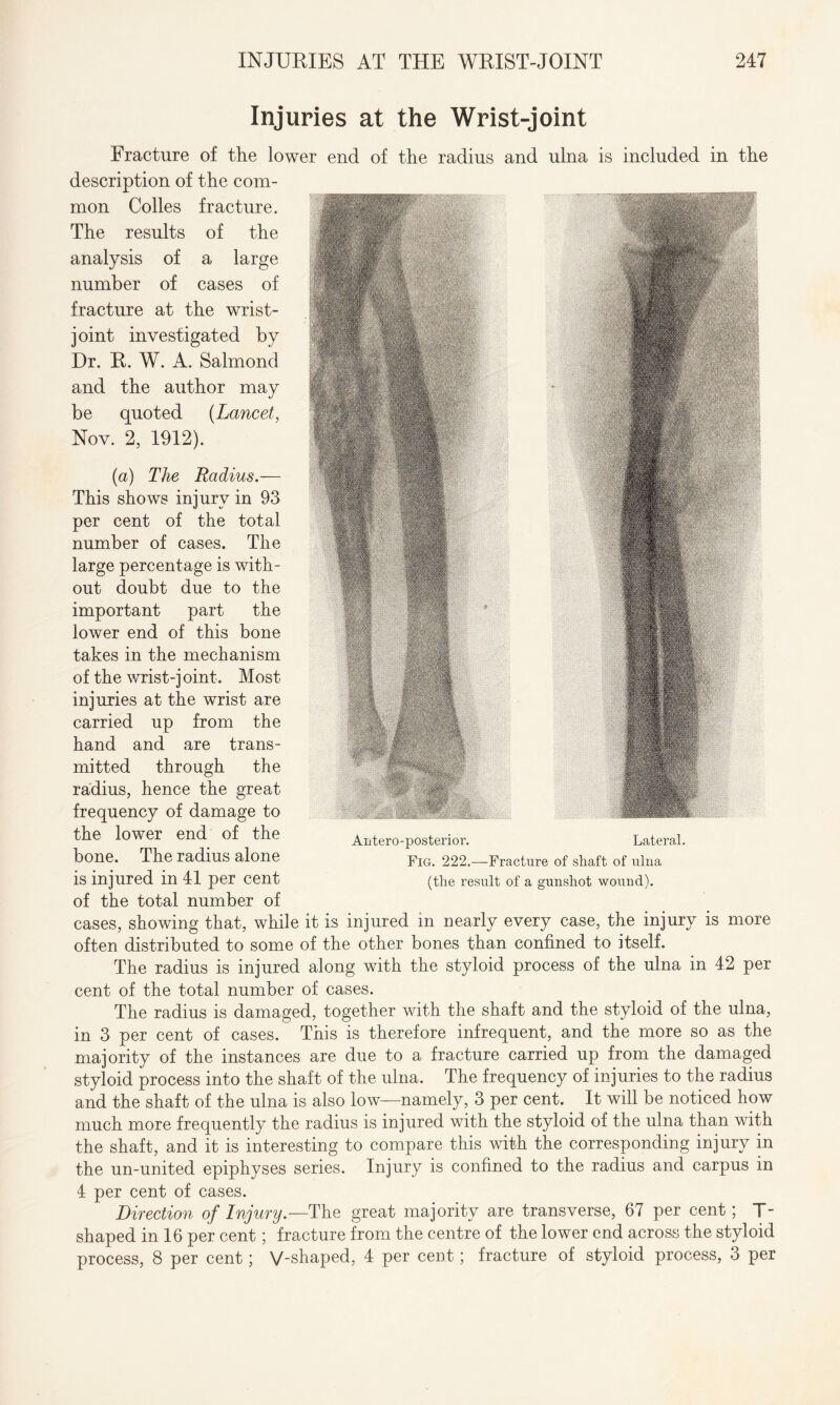 Injuries at the Wrist-joint Fracture of the lower end of the radius and ulna is included in the description of the com¬ mon Colles fracture. The results of the analysis of a large number of cases of fracture at the wrist- joint investigated by Dr. R. W. A. Salmond and the author may be quoted (Lancet, Nov. 2, 1912). ■ it —i ■ 1 ■ Antero-posterior. Lateral. (a) The Radius.— This shows injury in 93 per cent of the total number of cases. The large percentage is with¬ out doubt due to the important part the lower end of this bone takes in the mechanism of the wrist-joint. Most injuries at the wrist are carried up from the hand and are trans¬ mitted through the radius, hence the great frequency of damage to the lower end of the bone. The radius alone is injured in 41 per cent of the total number of cases, showing that, while it is injured in nearly every case, the injury is more often distributed to some of the other bones than confined to itself. The radius is injured along with the styloid process of the ulna in 42 per cent of the total number of cases. The radius is damaged, together with the shaft and the styloid of the ulna, in 3 per cent of cases. This is therefore infrequent, and the more so as the majority of the instances are due to a fracture carried up from the damaged styloid process into the shaft of the ulna. The frequency of injuries to the radius and the shaft of the ulna is also low—namely, 3 per cent. It will be noticed how much more frequently the radius is injured with the styloid of the ulna than with the shaft, and it is interesting to compare this with the corresponding injury in the un-united epiphyses series. Injury is confined to the radius and carpus in 4 per cent of cases. Direction of Injury.—The great majority are transverse, 67 per cent; T- shaped in 16 per cent; fracture from the centre of the lower end across the styloid process, 8 per cent; V-shaped, 4 per cent; fracture of styloid process, 3 per Fig. 222.—Fracture of shaft of ulna (the result of a gunshot wound).