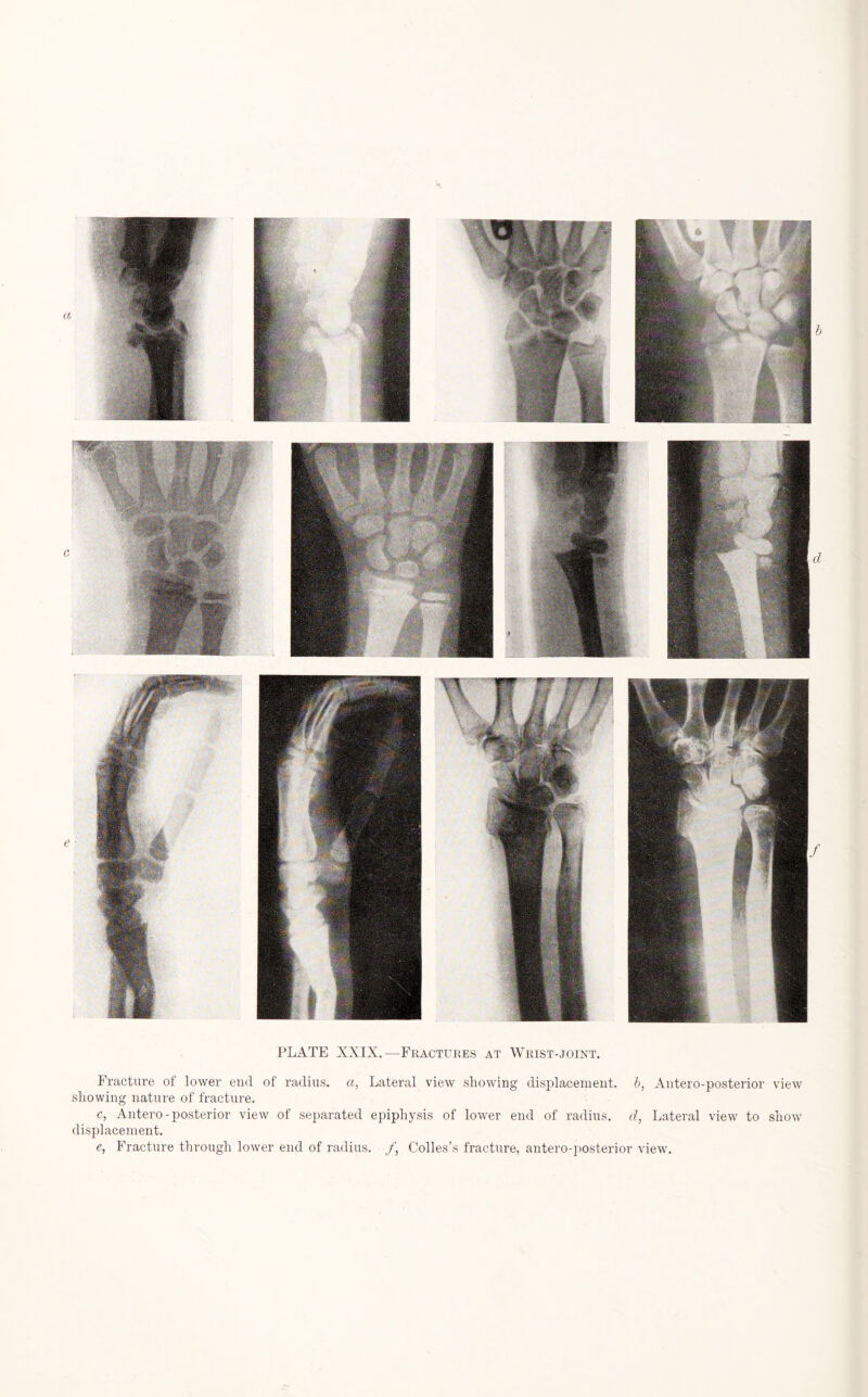 Fracture of lower end of radius, a, Lateral view showing displacement, b, Antero-posterior view showing nature of fracture. c, Antero-posterior view of separated epiphysis of lower end of radius, d, Lateral view to show displacement. e, Fracture through lower end of radius. /, Colies’s fracture, antero-posterior view.