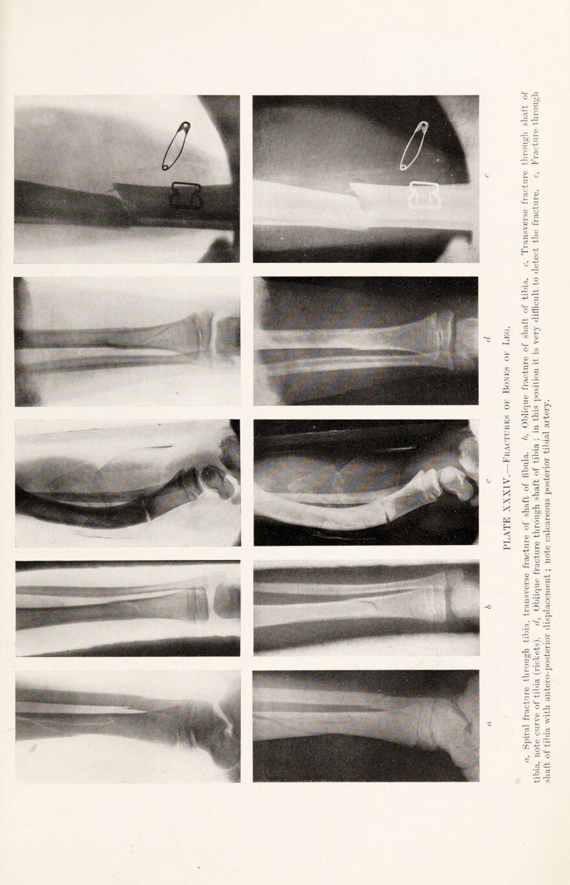 a, Spiral fracture through tibia, transverse fracture of shaft of fibula, b, Oblique fracture of shaft of tibia, c, Transverse fracture through shaft ot tibia, note curve of tibia (rickets), d, Oblique fracture through shaft of tibia ; in this position it is very difficult to detect the fracture, e, Fracture through shaft of tibia with antero-posterior displacement ; note calcareous posterior tibial artery.