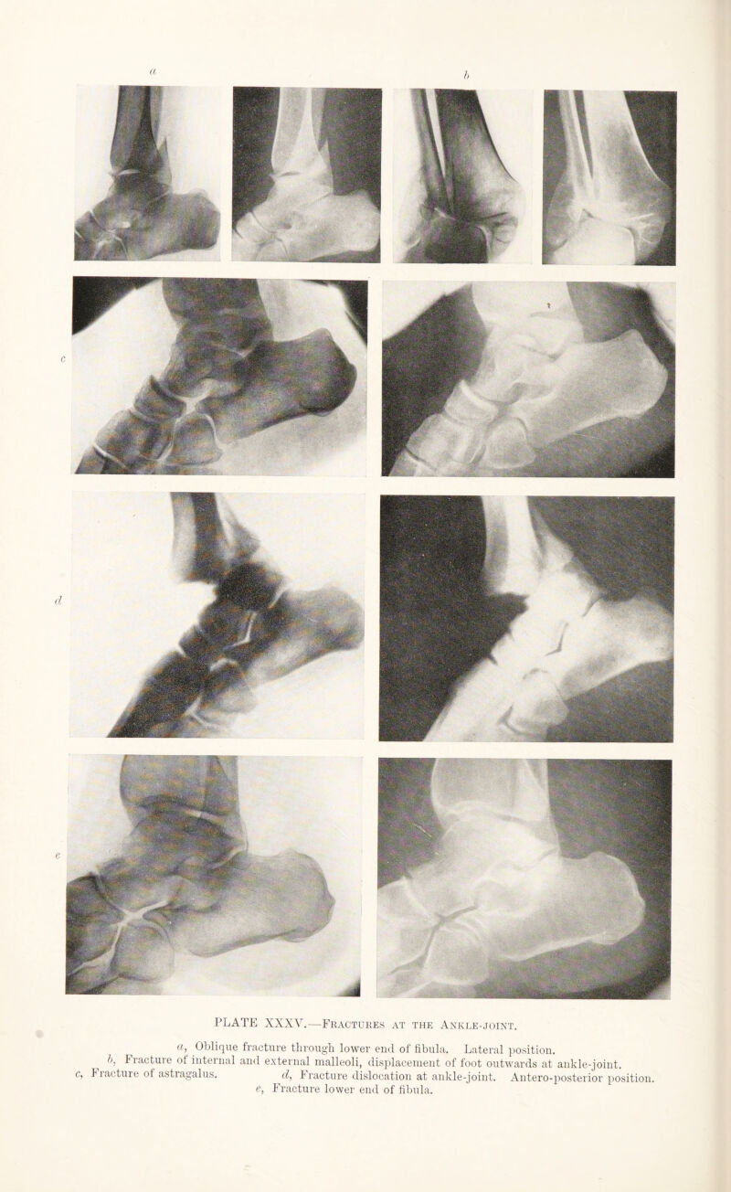 PLATE XXXV.—Fractures at the Ankle-joint. «, Oblique fracture through lower end of fibula. Lateral position. b, Fracture of internal and external malleoli, displacement of foot outwards at ankle-joint. c, Fiacture of astragalus. d, Fracture dislocation at ankle-joint. Antero-posterior position. e, Fracture lower end of fibula.