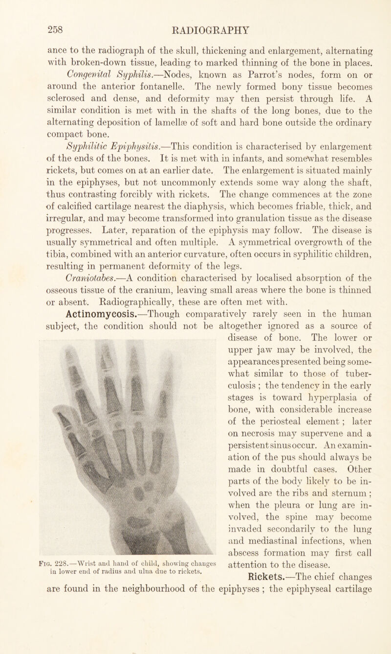 ance to the radiograph of the skull, thickening and enlargement, alternating with broken-down tissue, leading to marked thinning of the bone in places. Congenital Syphilis.—Nodes, known as Parrot’s nodes, form on or around the anterior fontanelle. The newly formed bony tissue becomes sclerosed and dense, and deformity may then persist through life. A similar condition is met with in the shafts of the long bones, due to the alternating deposition of lamellae of soft and hard bone outside the ordinary compact bone. Syphilitic Epiphysitis.—This condition is characterised by enlargement of the ends of the bones. It is met with in infants, and somewhat resembles rickets, but comes on at an earlier date. The enlargement is situated mainly in the epiphyses, but not uncommonly extends some way along the shaft, thus contrasting forcibly with rickets. The change commences at the zone of calcified cartilage nearest the diaphysis, which becomes friable, thick, and irregular, and may become transformed into granulation tissue as the disease progresses. Later, reparation of the epiphysis may follow. The disease is usually symmetrical and often multiple. A symmetrical overgrowth of the tibia, combined with an anterior curvature, often occurs in syphilitic children, resulting in permanent deformity of the legs. Craniotabes.—A condition characterised by localised absorption of the osseous tissue of the cranium, leaving small areas where the bone is thinned or absent. Radiographically, these are often met with. Actinomycosis.—Though comparatively rarely seen in the human subject, the condition should not be altogether ignored as a source of disease of bone. The lower or upper jaw may be involved, the appearances presented being some¬ what similar to those of tuber¬ culosis ; the tendency in the early stages is toward hyperplasia of bone, with considerable increase of the periosteal element ; later on necrosis may supervene and a persistent sinus occur. An examin¬ ation of the pus should always be made in doubtful cases. Other parts of the body likely to be in¬ volved are the ribs and sternum ; when the pleura or lung are in¬ volved, the spine may become invaded secondarily to the lung and mediastinal infections, when abscess formation may first call attention to the disease. Rickets.—The chief changes are found in the neighbourhood of the epiphyses ; the epiphyseal cartilage Fig. 228.—Wrist and hand of child, showing changes in lower end of radius and ulna due to rickets.