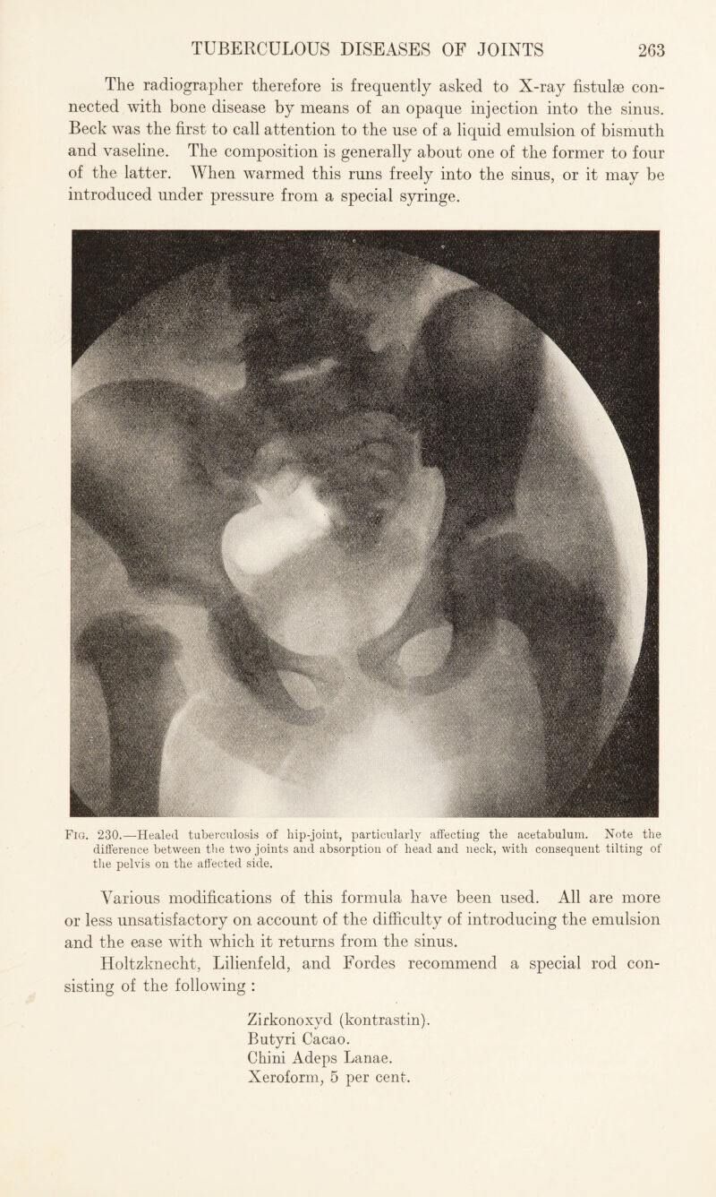 The radiographer therefore is frequently asked to X-ray fistulse con¬ nected with bone disease by means of an opaque injection into the sinus. Beck was the first to call attention to the use of a liquid emulsion of bismuth and vaseline. The composition is generally about one of the former to four of the latter. When warmed this runs freely into the sinus, or it may be introduced under pressure from a special syringe. Fig. 230.—Healed tuberculosis of hip-joint, particularly affecting the acetabulum. Hote the difference between the two joints and absorption of head and neck, with consequent tilting of the pelvis on the affected side. Various modifications of this formula have been used. All are more or less unsatisfactory on account of the difficulty of introducing the emulsion and the ease with which it returns from the sinus. Holtzknecht, Lilienfeld, and Fordes recommend a special rod con¬ sisting of the following : Zirkonoxyd (kontrastin). Butyri Cacao. Chini Adeps Lanae. Xeroform, 5 per cent.