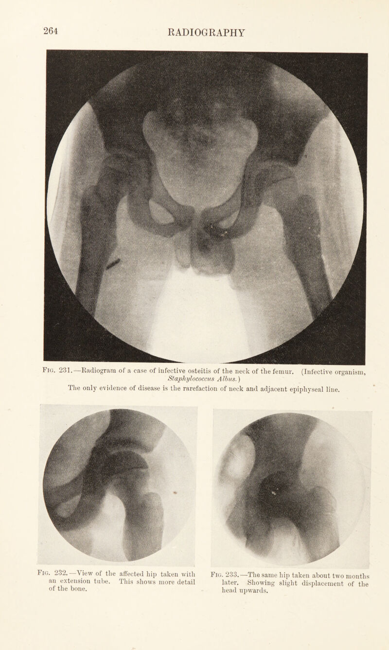 Fig. 231.—Radiogram of a case of infective osteitis of the neck of the femur. (Infective organism, Staphylococcus A Ibus.) The only evidence of disease is the rarefaction of neck and adjacent epiphyseal line. Fig. 232. —View of the affected hip taken with an extension tube. This shows more detail of the bone. Fig. 233.—The same hip taken about two months later. Showing slight displacement of the head upwards.