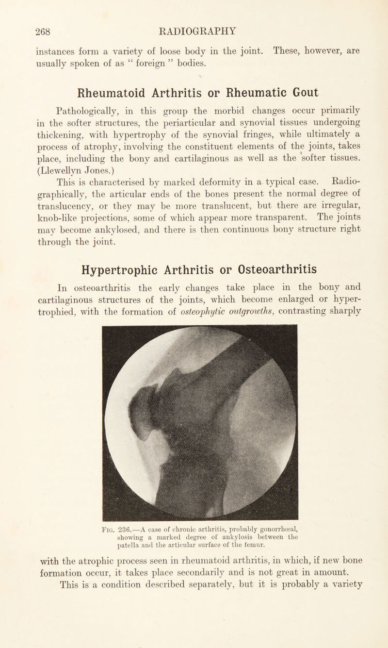 instances form a variety of loose body in the joint. These, however, are usually spoken of as “ foreign ” bodies. Rheumatoid Arthritis or Rheumatic Gout Pathologically, in this group the morbid changes occur primarily in the softer structures, the periarticular and synovial tissues undergoing thickening, with hypertrophy of the synovial fringes, while ultimately a process of atrophy, involving the constituent elements of the joints, takes place, including the bony and cartilaginous as well as the softer tissues. (Llewellyn Jones.) This is characterised by marked deformity in a typical case. Radio¬ graphically, the articular ends of the bones present the normal degree of translucency, or they may be more translucent, but there are irregular, knob-like projections, some of which appear more transparent. The joints may become ankylosed, and there is then continuous bony structure right through the joint. Hypertrophic Arthritis or Osteoarthritis In osteoarthritis the early changes take place in the bony and cartilaginous structures of the joints, which become enlarged or hyper¬ trophied, with the formation of osteophytic outgrowths, contrasting sharply Fig. 236.—A case of chronic arthritis, probably gonorrhoeal, showing a marked degree of ankylosis between the patella and the articular surface of the femur. with the atrophic process seen in rheumatoid arthritis, in which, if new bone formation occur, it takes place secondarily and is not great in amount. This is a condition described separately, but it is probably a variety