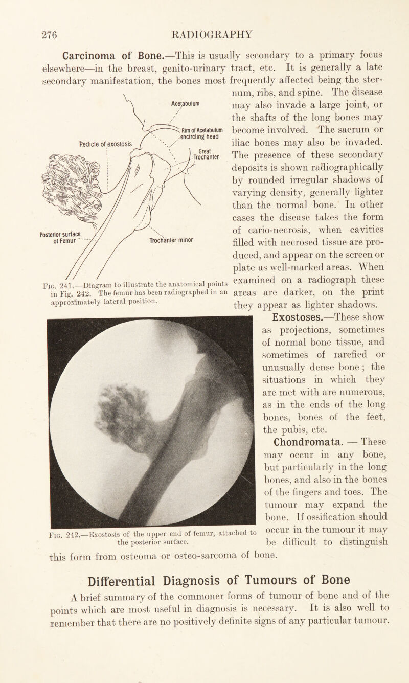 Rim of Acetabulum encircling head Great Trochanter Trochanter minor Carcinoma of Bone.—This is usually secondary to a primary focus elsewhere—in the breast, genito-urinary tract, etc. It is generally a late secondary manifestation, the bones most frequently affected being the ster¬ num, ribs, and spine. The disease Acetabulum may also invade a large joint, or the shafts of the long bones may become involved. The sacrum or iliac bones may also be invaded. The presence of these secondary deposits is shown radiographically by rounded irregular shadows of varying density, generally lighter than the normal bone. In other cases the disease takes the form of cario-necrosis, when cavities filled with necrosed tissue are pro¬ duced, and appear on the screen or plate as well-marked areas. When ' ........ , . , . . examined on a radiograph these in Fig. 242. The femur has been radiographed in an areas are darker, on the print they appear as lighter shadows. Exostoses.—These show as projections, sometimes of normal bone tissue, and sometimes of rarefied or unusually dense bone ; the situations in which they are met with are numerous, as in the ends of the long bones, bones of the feet, the pubis, etc. Chondromata. — These may occur in any bone, but particularly in the long bones, and also in the bones of the fingers and toes. The tumour may expand the bone. If ossification should of the upper end of femur, attached to OCCUI ill the tumour it may the posterior surface. be difficult to distinguish this form from osteoma or osteo-sarcoma of bone. approximately lateral position. Differential Diagnosis of Tumours of Bone A brief summary of the commoner forms of tumour of bone and of the points which are most useful in diagnosis is necessary. It is also well to remember that there are no positively definite signs of any particular tumour.