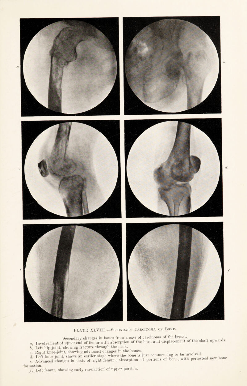 PLATE XLVIII.—Secondary Carcinoma of Bone. Secondary changes in bones from a case of carcinoma of the breast. Involvement of upper end of femur with absorption of the head and displacement of the shaft upwaidb. Left hip joint, showing fracture through the neck. Right knee-joint, showing advanced changes in the bones. _ . Left knee-joint, shows an earlier stage where the bone is just commencing to be involved , Advanced changes in shaft of right femur ; absorption of portions of bone, with periosteal new bone formation. /, Left femur, showing early rarefaction of upper portion. a, b, c, d, e,