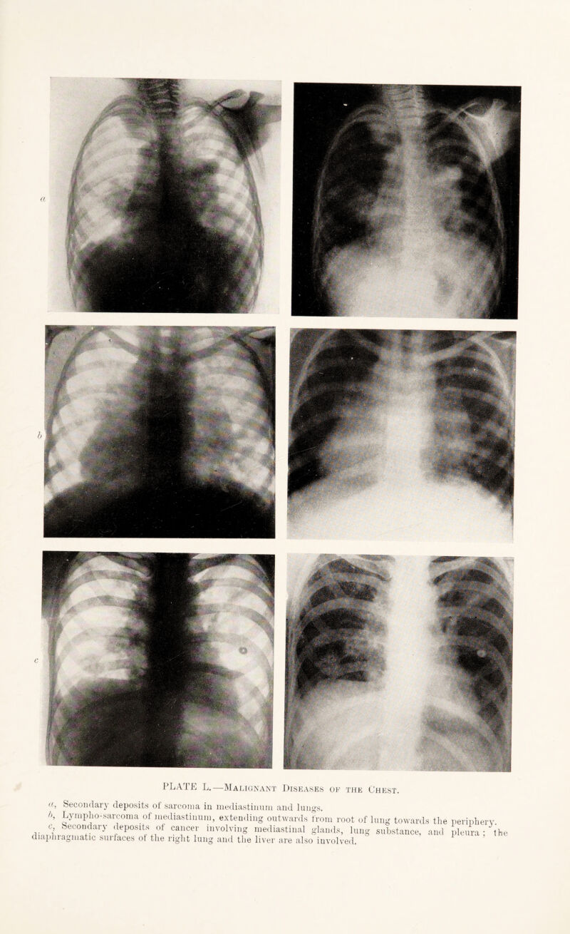 PLATE L.—Malignant Diseases oe the Chest. (C, Secondary deposits oi sarcoma in mediastinum and lungs. ,K Nympho-sarcoma of mediastinum, extending outwards from root of lung towards the periphery oecondarv deoosits of canner involving mo/Hao+mni m„ 1_ , 1 J c Secondary deposits of cancer involving mediastinal glands, lung substance, and pleura diaphragmatic surfaces ot the right lung and the liver are also involved. the