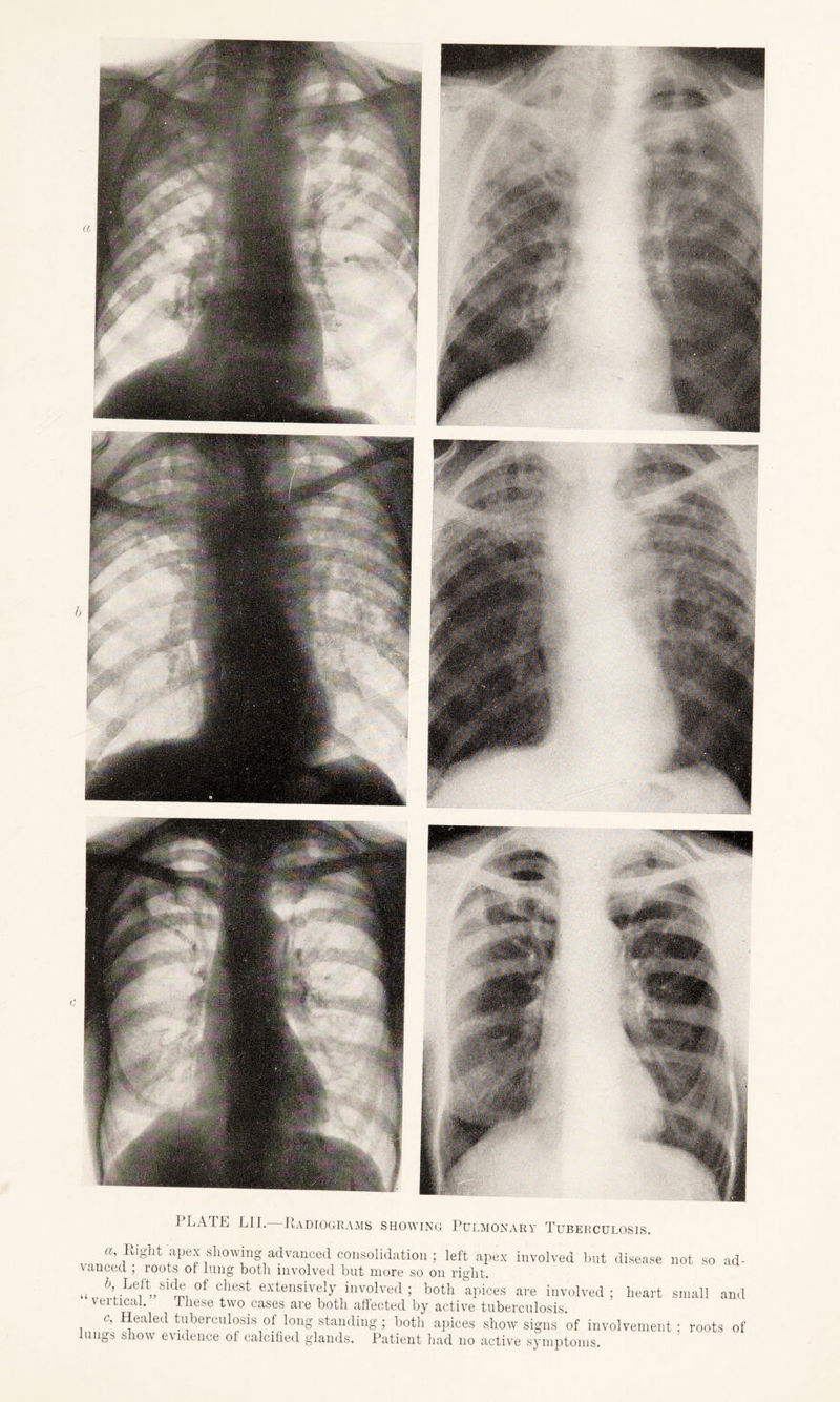 PLATE LII. Radiograms showing Pulmonary Tuberculosis. «, Right apex showing advanced consolidation ; left apex involved but disease not so ad- winced , loots of lung both involved but more so on right. „ J;.Le^Sld® of C4hest extensively involved; both apices are involved; heart small and vertical. these two cases are both affected by active tuberculosis. c, Healed tuberculosis of long standing ; both apices show signs of involvement : roots of ungs show evidence ol calcified glands. Patient had no active symptoms.