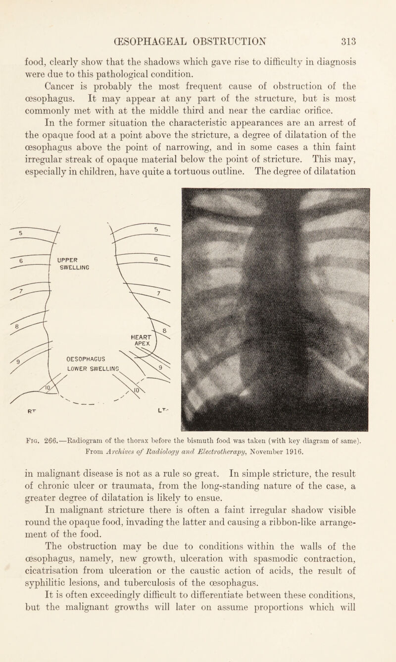 food, clearly show that the shadows which gave rise to difficulty in diagnosis were due to this pathological condition. Cancer is probably the most frequent cause of obstruction of the oesophagus. It may appear at any part of the structure, but is most commonly met with at the middle third and near the cardiac orifice. In the former situation the characteristic appearances are an arrest of the opaque food at a point above the stricture, a degree of dilatation of the oesophagus above the point of narrowing, and in some cases a thin faint irregular streak of opaque material below the point of stricture. This may, especially in children, have quite a tortuous outline. The degree of dilatation Fig. 266.—Radiogram of tlie thorax before the bismuth food was taken (with key diagram of same). From Archives of Radiology and Electrotherapy, November 1916. in malignant disease is not as a rule so great. In simple stricture, the result of chronic ulcer or traumata, from the long-standing nature of the case, a greater degree of dilatation is likely to ensue. In malignant stricture there is often a faint irregular shadow visible round the opaque food, invading the latter and causing a ribbon-like arrange¬ ment of the food. The obstruction may be due to conditions within the walls of the oesophagus, namely, new growth, ulceration with spasmodic contraction, cicatrisation from ulceration or the caustic action of acids, the result of syphilitic lesions, and tuberculosis of the oesophagus. It is often exceedingly difficult to differentiate between these conditions, but the malignant growths will later on assume proportions which will