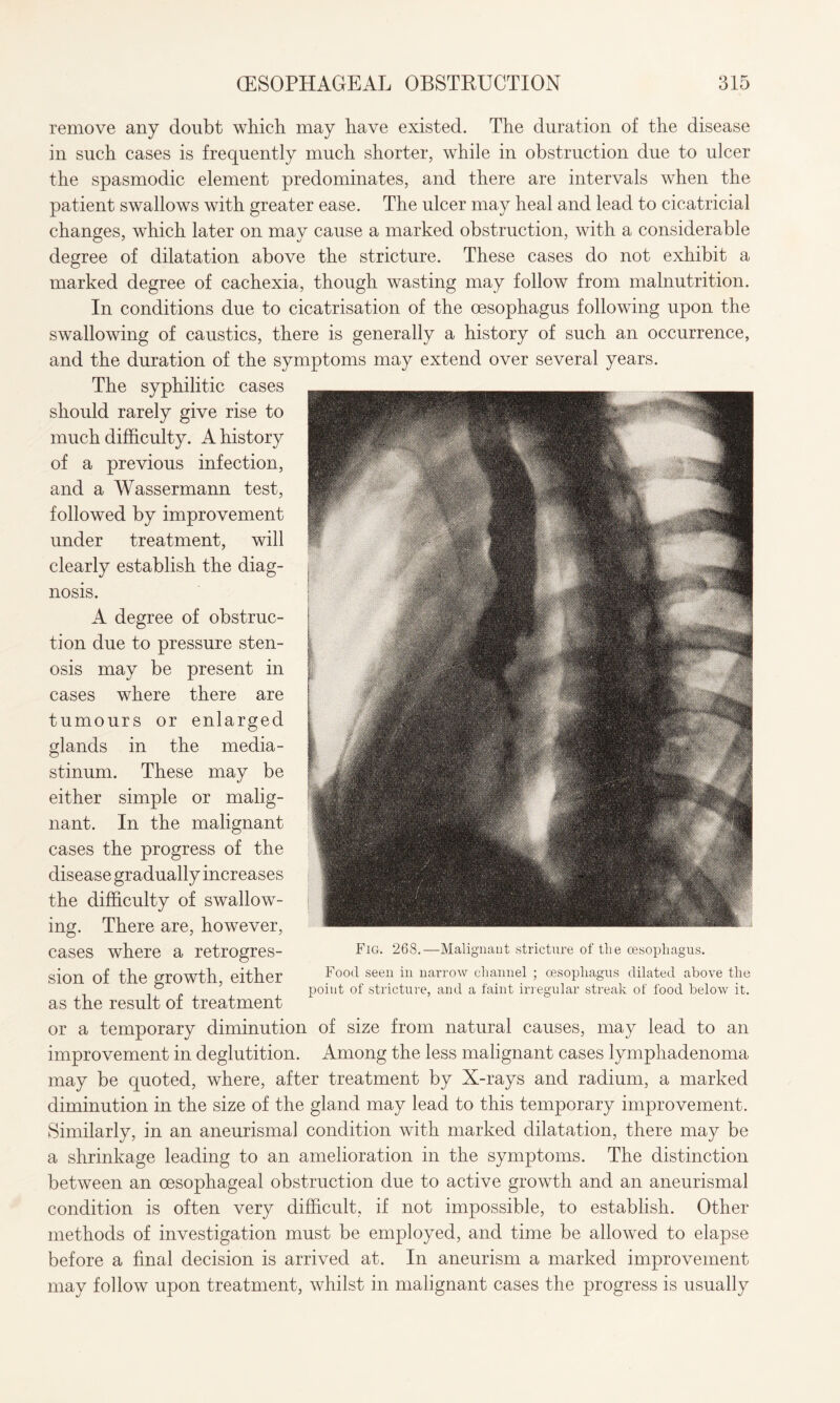 remove any doubt which may have existed. The duration of the disease in such cases is frequently much shorter, while in obstruction due to ulcer the spasmodic element predominates, and there are intervals when the patient swallows with greater ease. The ulcer may heal and lead to cicatricial changes, which later on may cause a marked obstruction, with a considerable degree of dilatation above the stricture. These cases do not exhibit a marked degree of cachexia, though wasting may follow from malnutrition. In conditions due to cicatrisation of the oesophagus following upon the swallowing of caustics, there is generally a history of such an occurrence, and the duration of the symptoms may extend over several years. The syphilitic cases should rarely give rise to much difficulty. A history of a previous infection, and a Wassermann test, followed by improvement under treatment, will clearly establish the diag¬ nosis. A degree of obstruc¬ tion due to pressure sten¬ osis may be present in cases where there are tumours or enlarged glands in the media¬ stinum. These may be either simple or malig¬ nant. In the malignant cases the progress of the disease gradually increases the difficulty of swallow¬ ing. There are, however, cases where a retrogres¬ sion of the growth, either as the result of treatment or a temporary diminution of size from natural causes, may lead to an improvement in deglutition. Among the less malignant cases lymphadenoma may be quoted, where, after treatment by X-rays and radium, a marked diminution in the size of the gland may lead to this temporary improvement. Similarly, in an aneurismal condition with marked dilatation, there may be a shrinkage leading to an amelioration in the symptoms. The distinction between an oesophageal obstruction due to active growth and an aneurismal condition is often very difficult, if not impossible, to establish. Other methods of investigation must be employed, and time be allowed to elapse before a final decision is arrived at. In aneurism a marked improvement may follow upon treatment, whilst in malignant cases the progress is usually Fig. 268.—Malignant stricture of tlie oesophagus. Food seen in narrow channel ; oesophagus dilated above the point of stricture, and a faint irregular streak of food below it.