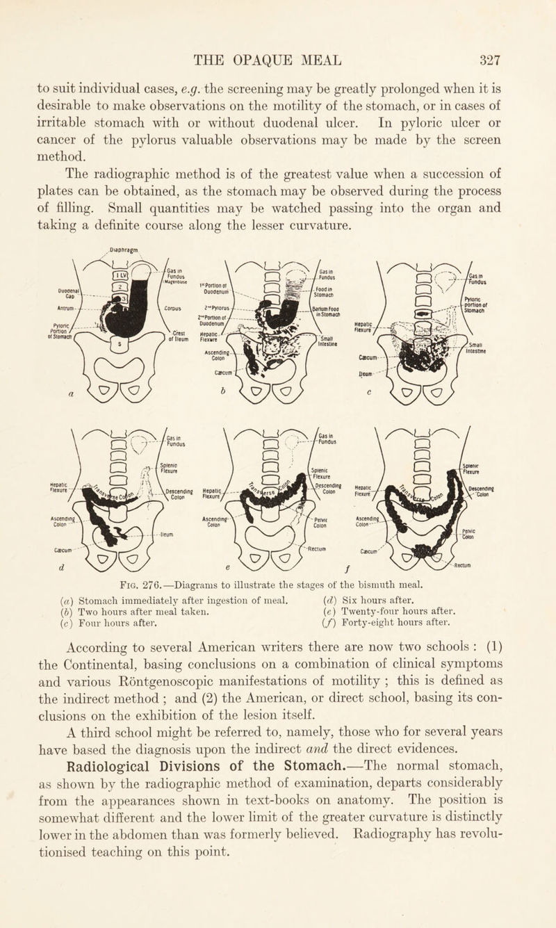 to suit individual cases, e.g. the screening may be greatly prolonged when it is desirable to make observations on the motility of the stomach, or in cases of irritable stomach with or without duodenal ulcer. In pyloric ulcer or cancer of the pylorus valuable observations may be made by the screen method. The radiographic method is of the greatest value when a succession of plates can be obtained, as the stomach may be observed during the process of filling. Small quantities may be watched passing into the organ and taking a definite course along the lesser curvature. / Fig. 276.—Diagrams to illustrate the stages of the bismuth, meal. (а) Stomach immediately after ingestion of meal. (d) Six hours after. (б) Two hours after meal taken. (e) Twenty-four hours after, (c) Four hours after. (/) Forty-eight hours after. According to several American writers there are now two schools : (1) the Continental, basing conclusions on a combination of clinical symptoms and various Rontgenoscopic manifestations of motility ; this is defined as the indirect method ; and (2) the American, or direct school, basing its con¬ clusions on the exhibition of the lesion itself. A third school might be referred to, namely, those who for several years have based the diagnosis upon the indirect and the direct evidences. Radiological Divisions of the Stomach.—The normal stomach, as shown by the radiographic method of examination, departs considerably from the appearances shown in text-books on anatomy. The position is somewhat different and the lower limit of the greater curvature is distinctly lower in the abdomen than was formerly believed. Radiography has revolu¬ tionised teaching on this point.