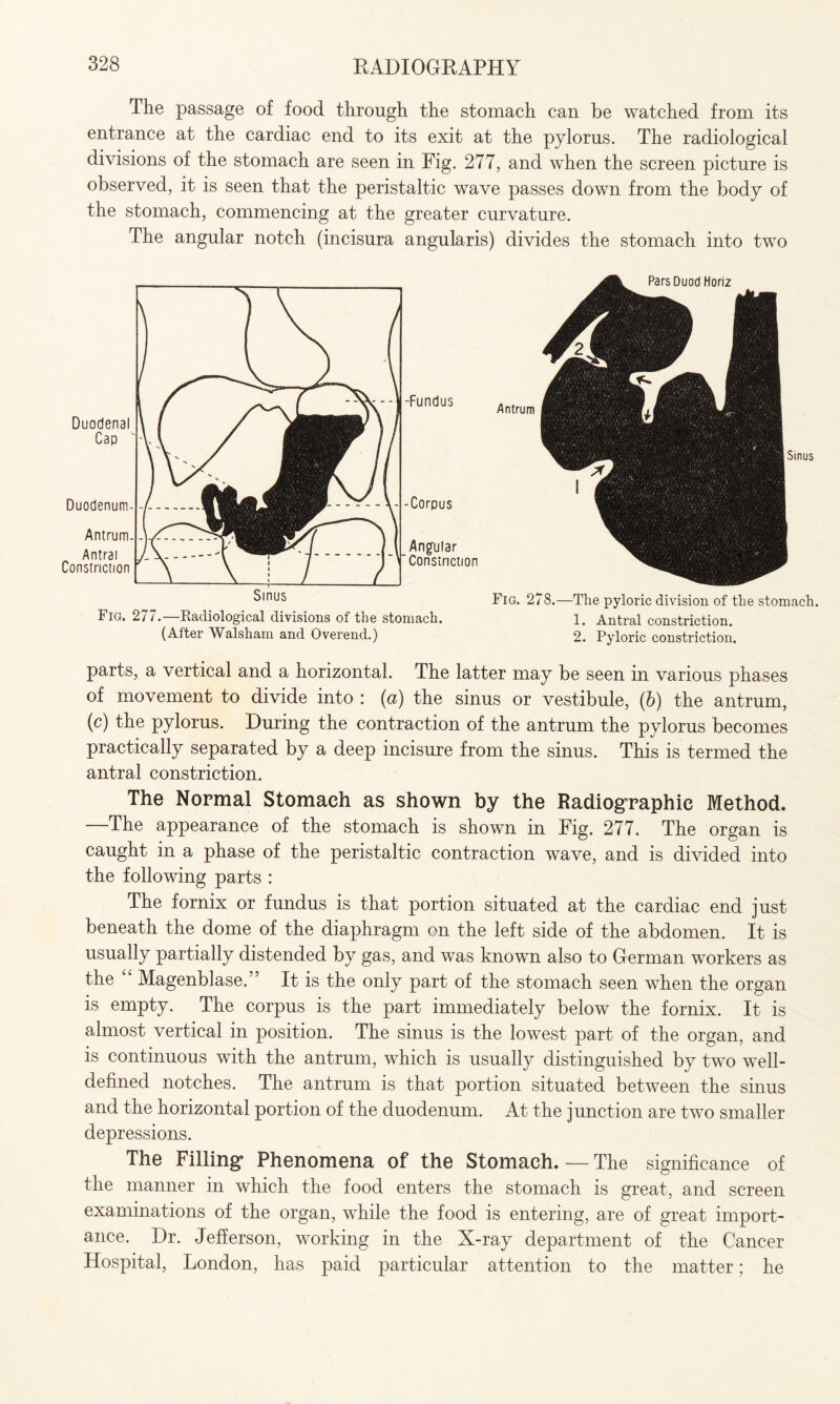 The passage of food through the stomach can be watched from its entrance at the cardiac end to its exit at the pylorus. The radiological divisions of the stomach are seen in Fig. 277, and when the screen picture is observed, it is seen that the peristaltic wave passes down from the body of the stomach, commencing at the greater curvature. The angular notch (incisura angularis) divides the stomach into two Sinus Sinus Fig. 277.—Radiological divisions of the stomach. (After Walsham and Overend.) Fig. 278.—The pyloric division of the stomach. 1. Antral constriction. 2. Pyloric constriction. parts, a vertical and a horizontal. The latter may be seen in various phases of movement to divide into : (a) the sinus or vestibule, (b) the antrum, (c) the pylorus. During the contraction of the antrum the pylorus becomes practically separated by a deep incisure from the sinus. This is termed the antral constriction. The Normal Stomach as shown by the Radiographic Method. —The appearance of the stomach is shown in Fig. 277. The organ is caught in a phase of the peristaltic contraction wave, and is divided into the following parts : The fornix or fundus is that portion situated at the cardiac end just beneath the dome of the diaphragm on the left side of the abdomen. It is usually partially distended by gas, and was known also to German workers as the “ Magenblase.” It is the only part of the stomach seen when the organ is empty. The corpus is the part immediately below the fornix. It is almost vertical in position. The sinus is the lowest part of the organ, and is continuous with the antrum, which is usually distinguished by two well- defined notches. The antrum is that portion situated between the sinus and the horizontal portion of the duodenum. At the junction are two smaller depressions. The Filling* Phenomena of the Stomach. — The significance of the manner in which the food enters the stomach is great, and screen examinations of the organ, while the food is entering, are of great import¬ ance. Dr. Jefferson, working in the X-ray department of the Cancer Hospital, London, has paid particular attention to the matter; he