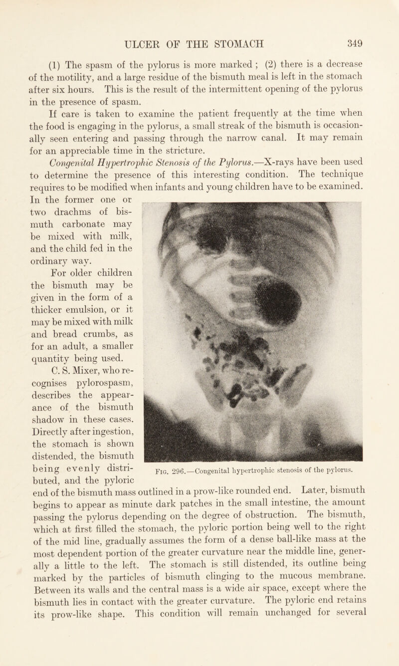 (1) The spasm of the pylorus is more marked ; (2) there is a decrease of the motility, and a large residue of the bismuth meal is left in the stomach after six hours. This is the result of the intermittent opening of the pylorus in the presence of spasm. If care is taken to examine the patient frequently at the time when the food is engaging in the pylorus, a small streak of the bismuth is occasion¬ ally seen entering and passing through the narrow canal. It may remain for an appreciable time in the stricture. Congenital Hypertrophic Stenosis of the Pylorus.—X-rays have been used to determine the presence of this interesting condition. The technique requires to be modified when infants and young children have to be examined. In the former one or two drachms of bis¬ muth carbonate may be mixed with milk, and the child fed in the ordinary way. For older children the bismuth may be given in the form of a thicker emulsion, or it may be mixed with milk and bread crumbs, as for an adult, a smaller quantity being used. C. S. Mixer, who re¬ cognises pylorospasm, describes the appear¬ ance of the bismuth shadow in these cases. Directly after ingestion, the stomach is shown distended, the bismuth being evenly distri¬ buted, and the pyloric end of the bismuth mass outlined in a prow-like rounded end. Later, bismuth begins to appear as minute dark patches in the small intestine, the amount passing the pylorus depending on the degree of obstruction. The bismuth, which at first filled the stomach, the pyloric portion being well to the right of the mid line, gradually assumes the form of a dense ball-like mass at the most dependent portion of the greater curvature near the middle line, gener¬ ally a little to the left. The stomach is still distended, its outline being marked by the particles of bismuth clinging to the mucous membrane. Between its walls and the central mass is a wide air space, except where the bismuth lies in contact with the greater curvature. The pyloric end retains its prow-like shape. This condition will remain unchanged for several