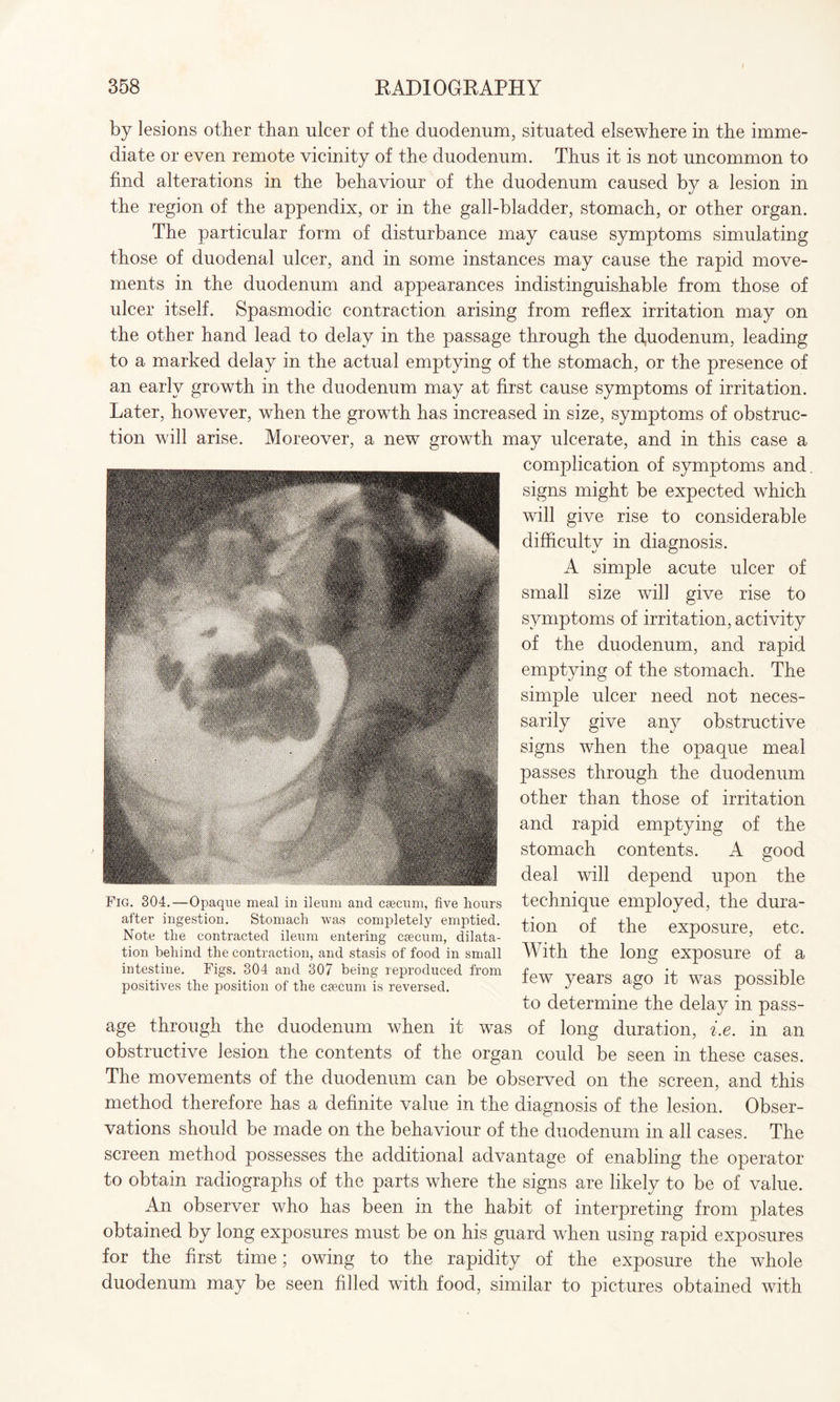 by lesions other than ulcer of the duodenum, situated elsewhere in the imme¬ diate or even remote vicinity of the duodenum. Thus it is not uncommon to find alterations in the behaviour of the duodenum caused by a lesion in the region of the appendix, or in the gall-bladder, stomach, or other organ. The particular form of disturbance may cause symptoms simulating those of duodenal ulcer, and in some instances may cause the rapid move¬ ments in the duodenum and appearances indistinguishable from those of ulcer itself. Spasmodic contraction arising from reflex irritation may on the other hand lead to delay in the passage through the cfiiodenum, leading to a marked delay in the actual emptying of the stomach, or the presence of an early growth in the duodenum may at first cause symptoms of irritation. Later, however, when the growth has increased in size, symptoms of obstruc¬ tion will arise. Moreover, a new growth may ulcerate, and in this case a complication of symptoms and. signs might be expected which will give rise to considerable difficulty in diagnosis. A simple acute ulcer of small size will give rise to symptoms of irritation, activity of the duodenum, and rapid emptying of the stomach. The simple ulcer need not neces¬ sarily give any obstructive signs when the opaque meal passes through the duodenum other than those of irritation and rapid emptying of the stomach contents. A good deal will depend upon the technique employed, the dura¬ tion of the exposure, etc. With the long exposure of a few years ago it was possible to determine the delay in pass¬ age through the duodenum when it was of long duration, i.e. in an obstructive lesion the contents of the organ could be seen in these cases. The movements of the duodenum can be observed on the screen, and this method therefore has a definite value in the diagnosis of the lesion. Obser¬ vations should be made on the behaviour of the duodenum in all cases. The screen method possesses the additional advantage of enabling the operator to obtain radiographs of the parts where the signs are likely to be of value. An observer who has been in the habit of interpreting from plates obtained by long exposures must be on his guard when using rapid exposures for the first time; owing to the rapidity of the exposure the whole duodenum may be seen filled with food, similar to pictures obtained with Fig. 304.—Opaque meal in ileum and caecum, five hours after ingestion. Stomach was completely emptied. Note the contracted ileum entering caecum, dilata¬ tion behind the contraction, and stasis of food in small intestine. Figs. 304 and 307 being reproduced from positives the position of the caecum is reversed.