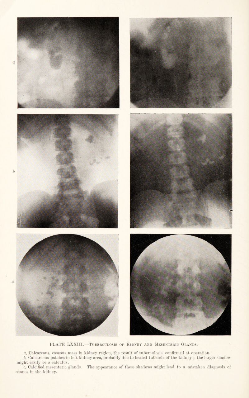 PLATE LXXIII.—Tuberculosis ou Kidney and Mesenteric Glands. a, Calcareous, caseous mass in kidney region, the result of tuberculosis, confirmed at operation. b, Calcareous patches in left kidney area, probably due to healed tubercle of the kidney ; the larger shadow might easily be a calculus. c, Calcified mesenteric glands. The appearance of these shadows might lead to a mistaken diagnosis of .stones in the kidney.