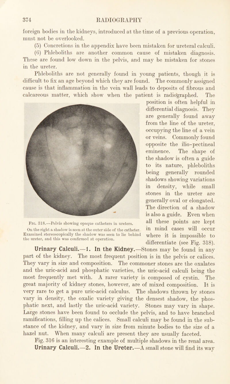 foreign bodies in the kidneys, introduced at the time of a previous operation, must not be overlooked. (5) Concretions in the appendix have been mistaken for ureteral calculi. (6) Phleboliths are another common cause of mistaken diagnosis. These are found low down in the pelvis, and may be mistaken for stones in the ureter. Phleboliths are not generally found in young patients, though it is difficult to fix an age beyond which they are found. The commonly assigned cause is that inflammation in the vein wall leads to deposits of fibrous and calcareous matter, which show when the patient is radiographed. The position is often helpful in differential diagnosis. They are generally found away from the line of the ureter, occupying the line of a vein or veins. Commonly found opposite the ilio-pectineal eminence. The shape of the shadow is often a guide to its nature, phleboliths being generally rounded shadows showing variations in density, while small stones in the ureter are generally oval or elongated. The direction of a shadow is also a guide. Even when all these points are kept in mind cases will occur where it is impossible to differentiate (see Fig. 318). Urinary Calculi.—1. In the Kidney.—Stones may be found in any part of the kidney. The most frequent position is in the pelvis or calices. They vary in size and composition. The commoner stones are the oxalates and the uric-acid and phosphatic varieties, the uric-acid calculi being the most frequently met with. A rarer variety is composed of cystin. The great majority of kidney stones, however, are of mixed composition. It is very rare to get a pure uric-acid calculus. The shadows thrown by stones vary in density, the oxalic variety giving the densest shadow, the phos¬ phatic next, and lastly the uric-acid variety. Stones may vary in shape. Large stones have been found to occlude the pelvis, and to have branched ramifications, filling up the calices. Small calculi may be found in the sub¬ stance of the kidney, and vary in size from minute bodies to the size of a hazel nut. When many calculi are present they are usually faceted. Fig. 316 is an interesting example of multiple shadows in the renal area. Urinary Calculi.—2. In the Ureter.—A small stone will find its way Fig. 318.—Pelvis showing opaque catheters in ureters. On the right a shadow is seen at the outer side of the catheter. Examined stereoscopically the shadow was seen to lie behind the ureter, and this was confirmed at operation.