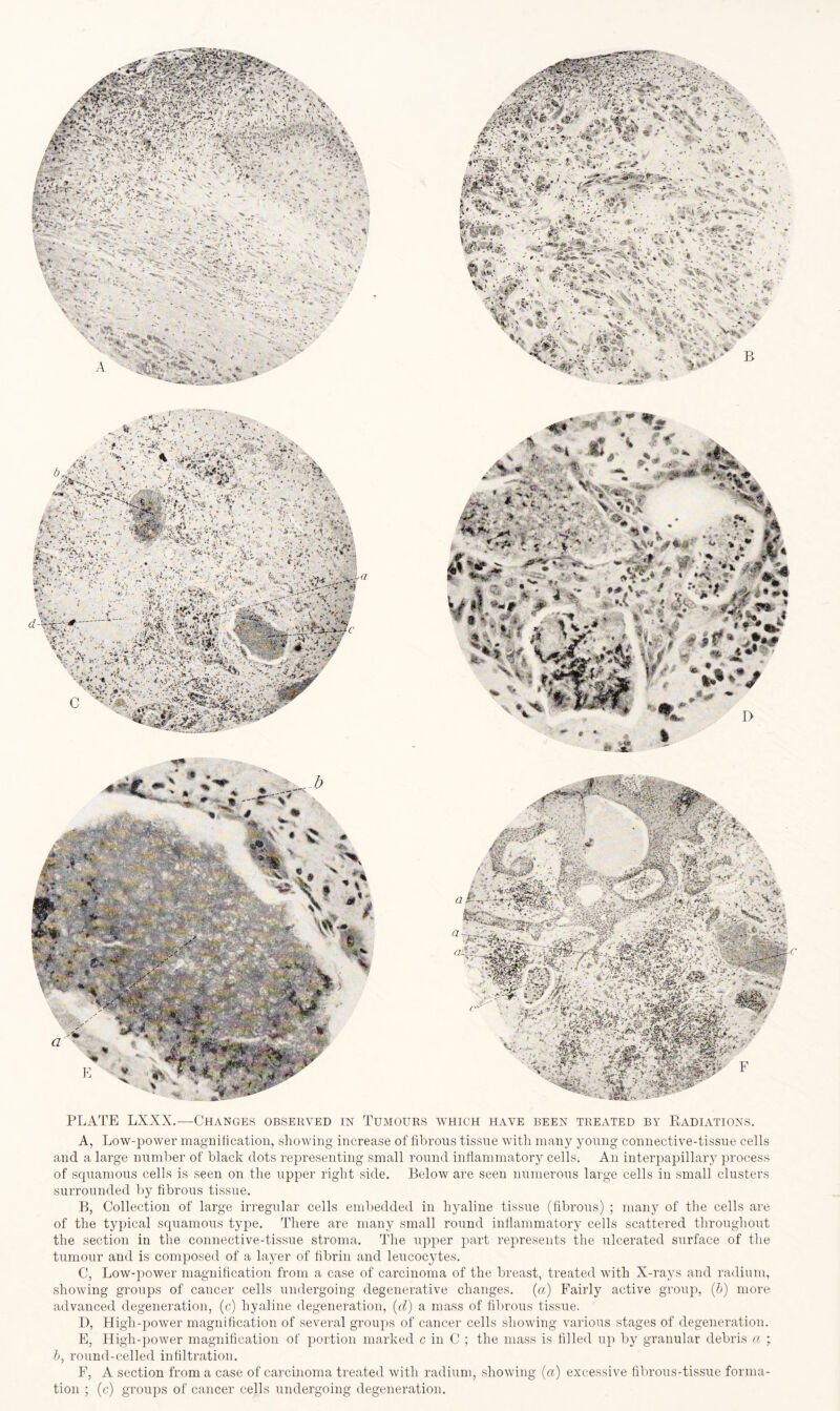 s' v.r 1 *  V % \ ' Sfr-M ,*k 't* ~ > A ‘‘-v A-’, \ ••■••*■ .** • * * ft- t. 5 ■' df ' * , % AJ| % • * ' * *V4 ; * .*>• ft * < «f -j#., ** _«* # “ * * **• A# P'0 P ^ t ^/ . • £. $ 4^41 K< i • ' -;• ms* i ■ '•’•s i»*V PLATE LXXX.—Changes observed in Tumours which have been treated by Radiations. A, Low-power magnification, showing increase of fibrous tissue with many young connective-tissue cells and a large number of black dots representing small round inflammatory cells. An interpapillary process of squamous cells is seen on the upper right side. Below are seen numerous large cells in small clusters surrounded by fibrous tissue. B, Collection of large irregular cells embedded in hyaline tissue (fibrous) ; many of the cells are of the typical squamous type. There are many small round inflammatory cells scattered throughout the section in the connective-tissue stroma. The upper part represents the ulcerated surface of the tumour and is composed of a layer of fibrin and leucocytes. C, Low-power magnification from a case of carcinoma of the breast, treated with X-rays and radium, showing groups of cancer cells undergoing degenerative changes, (a) Fairly active group, (&) more advanced degeneration, (c) hyaline degeneration, (d) a mass of fibrous tissue. D, High-power magnification of several groups of cancer cells showing various stages of degeneration. E, High-power magnification of portion marked c in C ; the mass is filled up by granular debris a ; b, round-celled infiltration. F, A section from a case of carcinoma treated with radium, showing (a) excessive fibrous-tissue forma¬ tion ; (c) groups of cancer cells undergoing degeneration.