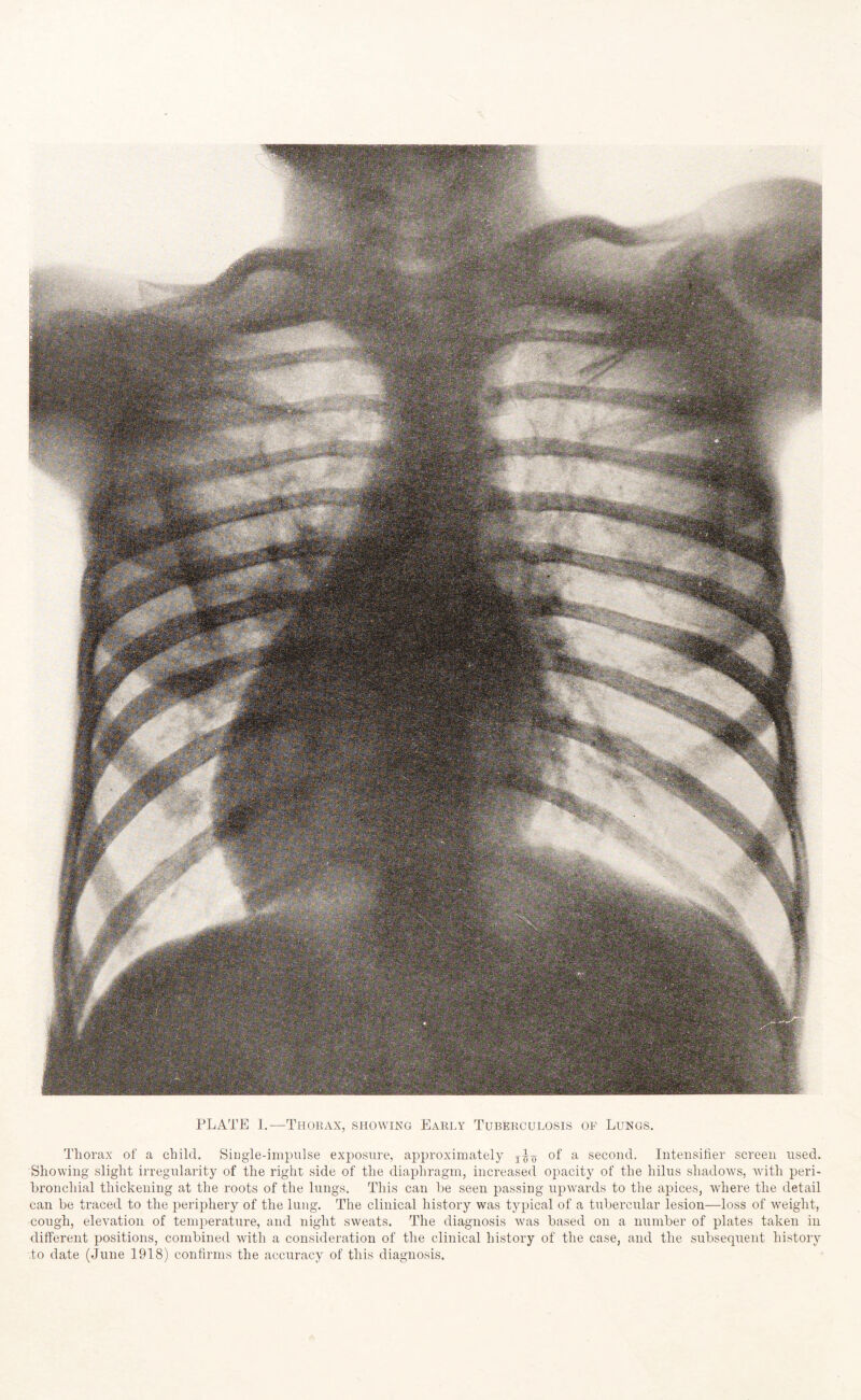 PLATE I.-—Thorax, showing Early Tuberculosis of Lungs. Thorax of a child. Single-impulse exposure, approximately of a second. Intensifier screen used. Showing slight irregularity of the right side of the diaphragm, increased opacity of the hilus shadows, with peri¬ bronchial thickening at the roots of the lungs. This can be seen passing upwards to the apices, where the detail can be traced to the periphery of the lung. The clinical history was typical of a tubercular lesion—loss of weight, cough, elevation of temperature, and night sweats. The diagnosis was based on a number of plates taken in different positions, combined with a consideration of the clinical history of the case, and the subsequent history