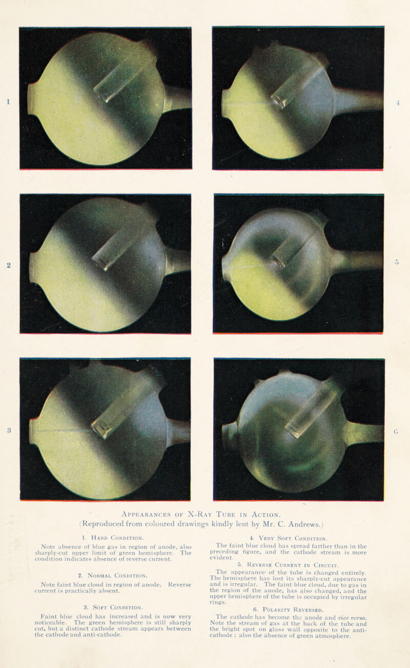 Appearances of X-Ray Tube in Action. (Reproduced from coloured drawings kindly lent by Mr. C. Andrews.) 1. Hard Condition. Note absence of blue gas in region of anode, also sharply-cut upper limit of green hemisphere. The condition indicates absence of reverse current. 2. Normal Condition. Note faint blue cloud in region of anode. Reverse current is practically absent. 3. Soft Condition. Faint blue cloud has increased and is now very noticeable. The green hemisphere is still sharply cut, but a distinct cathode stream appears between the cathode and anti-cathode. 4. Very Soft Condition. The faint blue cloud has spread farther than in the preceding figure, and the cathode stream is more evident. 5. Reverse Current in Circuit. The appearance1 of the tube is changed entirely. The hemisphere has lost its sharply-cut appearance and is irregular. The faint blue cloud, due to gas in the region of the anode, has also changed, and the upper hemisphere of the tube is occupied by irregular rings. 6. Polarity Reversed. The cathode has become the anode and vice versa. Note the stream of gas at the back of the tube and the bright spot on glass wall opposite to the anti¬ cathode ; also the absence of green atmosphere.