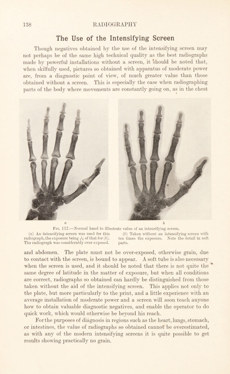 The Use of the Intensifying Screen Though negatives obtained by the use of the intensifying screen may not perhaps be of the same high technical quality as the best radiographs made by powerful installations without a screen, it ’should be noted that, when skilfully used, pictures so obtained with apparatus of moderate power are, from a diagnostic point of view, of much greater value than those obtained without a screen. This is especially the case when radiographing parts of the body where movements are constantly going on, as in the chest a b Fig. 117.—Normal hand to illustrate value of an intensifying screen. (ia) An intensifying screen was used for this (b) Taken without an intensifying screen with radiograph, the exposure being y1-^ of that for (6). ten times the exposure. Note the detail in soft The radiograph was considerably over-exposed. parts. and abdomen. The plate must not be over-exposed, otherwise grain, due to contact with the screen, is bound to appear. A soft tube is also necessary when the screen is used, and it should be noted that there is not quite the same degree of latitude in the matter of exposure, but when all conditions are correct, radiographs so obtained can hardly be distinguished from those taken without the aid of the intensifying screen. This applies not only to the plate, but more particularly to the print, and a little experience with an average installation of moderate power and a screen will soon teach anyone how to obtain valuable diagnostic negatives, and enable the operator to do quick work, which would otherwise be beyond his reach. For the purposes of diagnosis in regions such as the heart, lungs, stomach, or intestines, the value of radiographs so obtained cannot be overestimated, as with any of the modern intensifying screens it is quite possible to get results showing practically no grain.